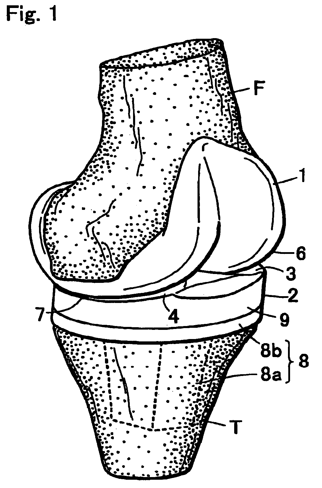 Artificial knee joint