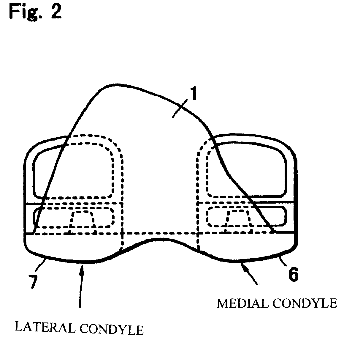 Artificial knee joint