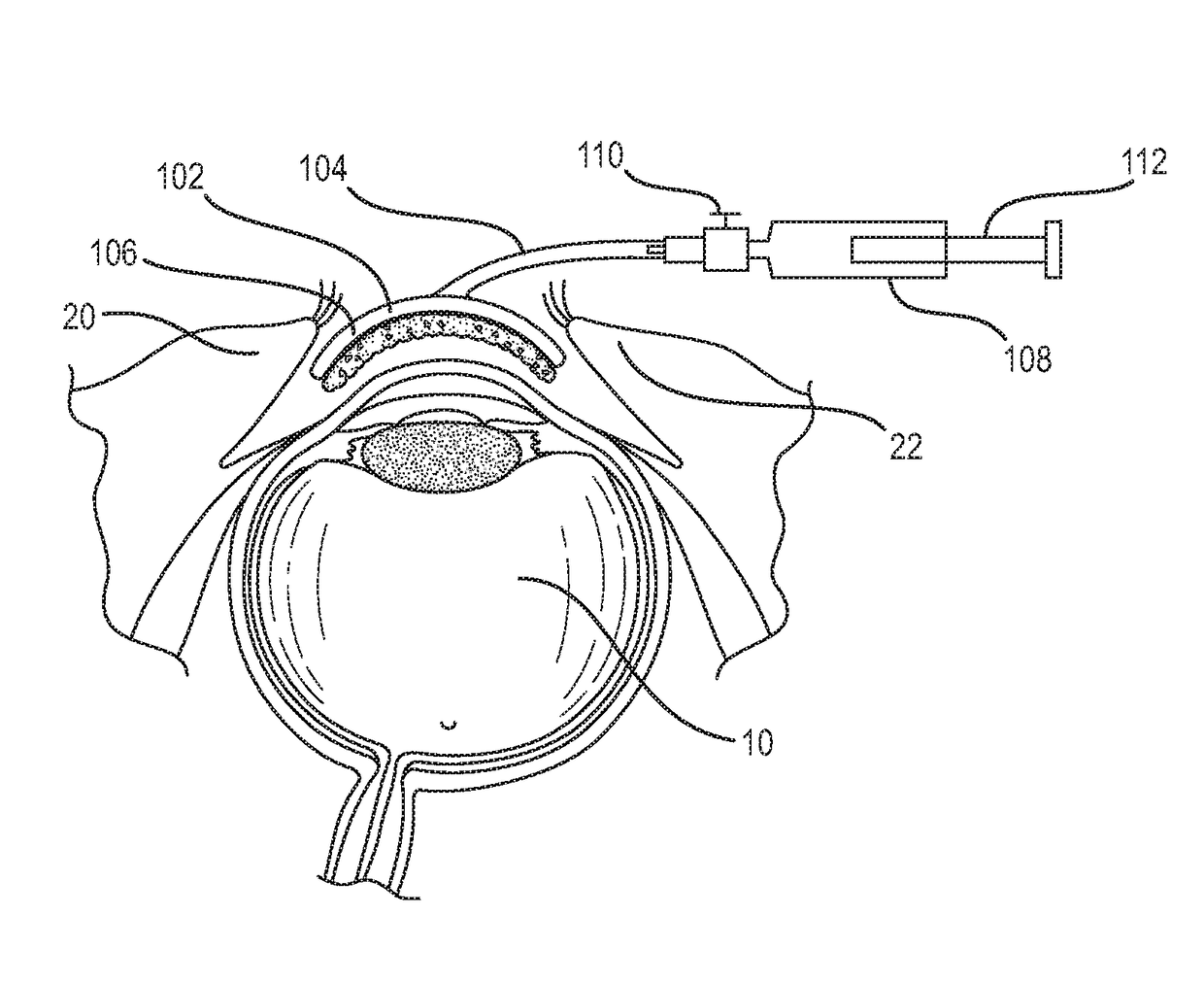 System and method for the delivery of medications or fluids to the eye