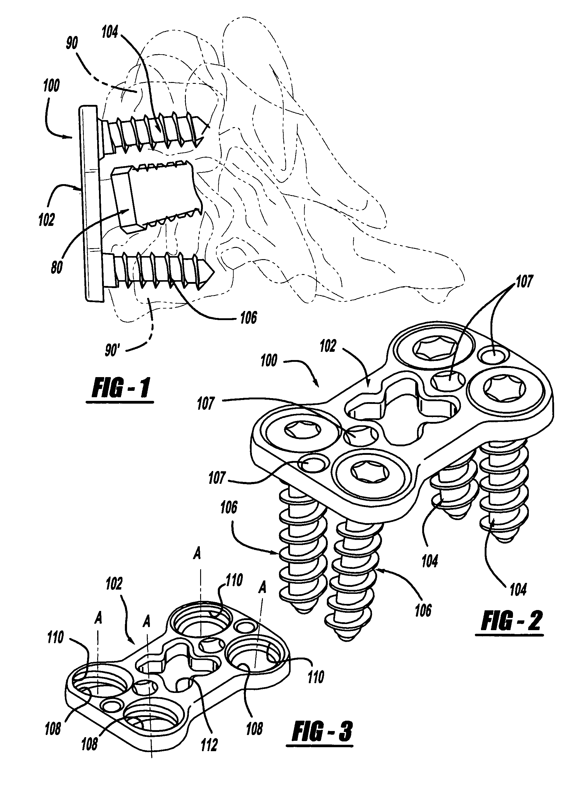 Bone fixation system