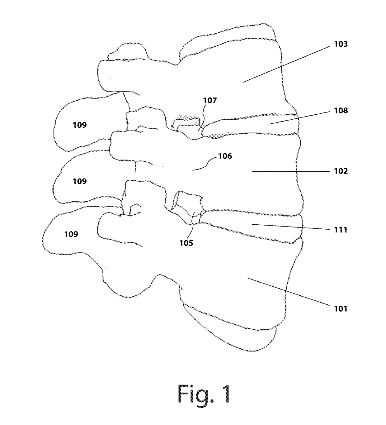 Rodless bivertebral transpedicular fixation with interbody fusion