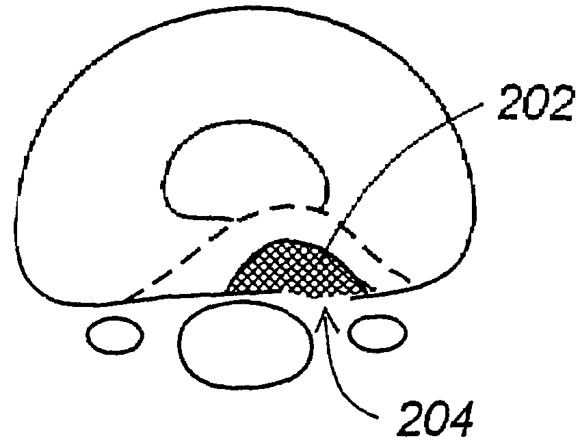 Methods for treating a defect in the annulus fibrosis