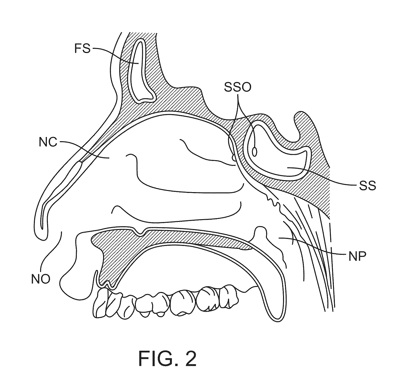 Devices and methods for inserting a sinus dilator