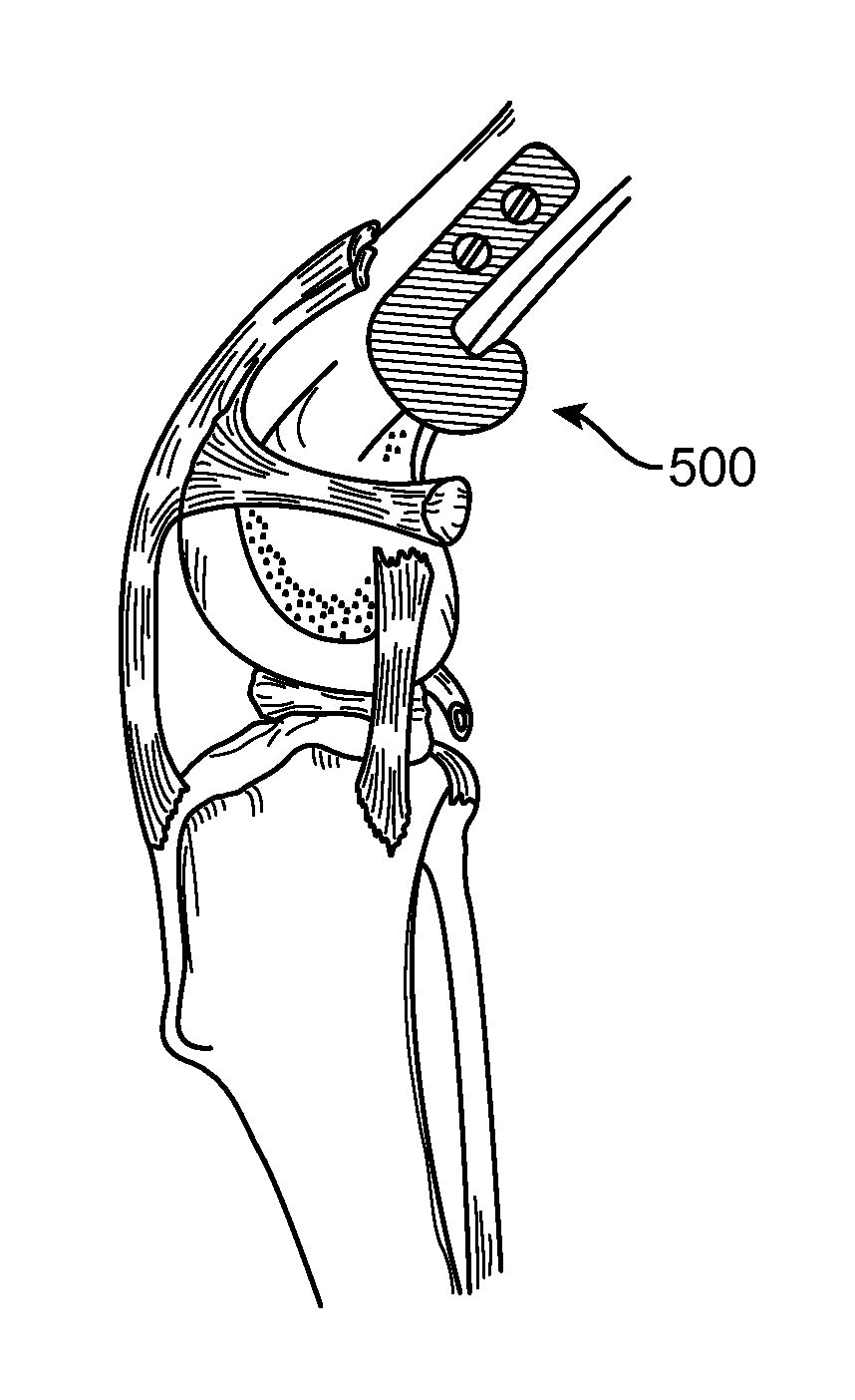 Method and Apparatus For Treating Canine Cruciate Ligament Disease