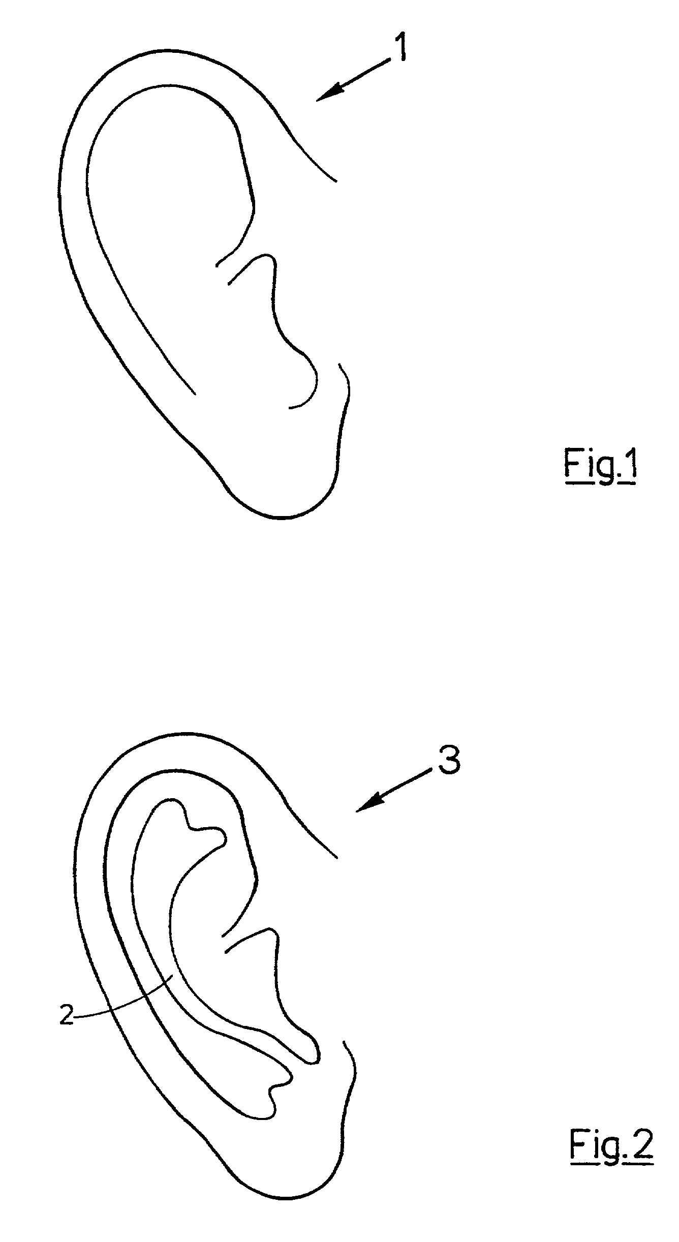 Device for non-invasively correcting the shape of a human external ear