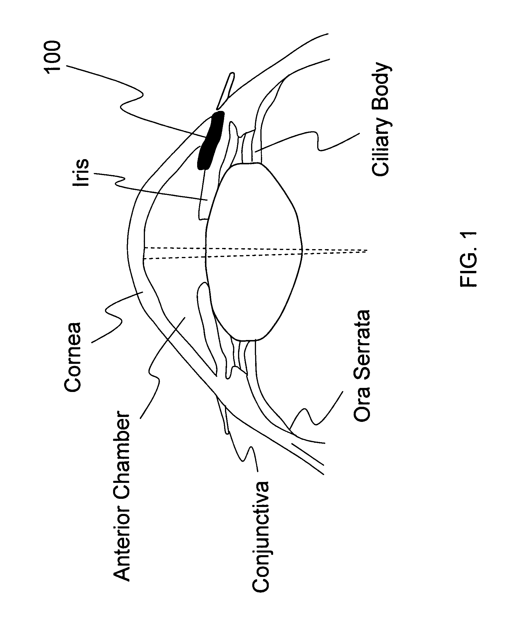 Implantable glaucoma drainage device