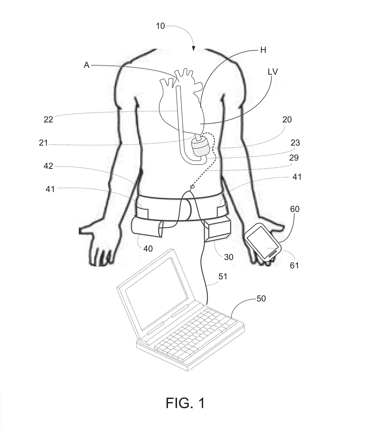 Implantable pump system having an undulating membrane with improved hydraulic performance