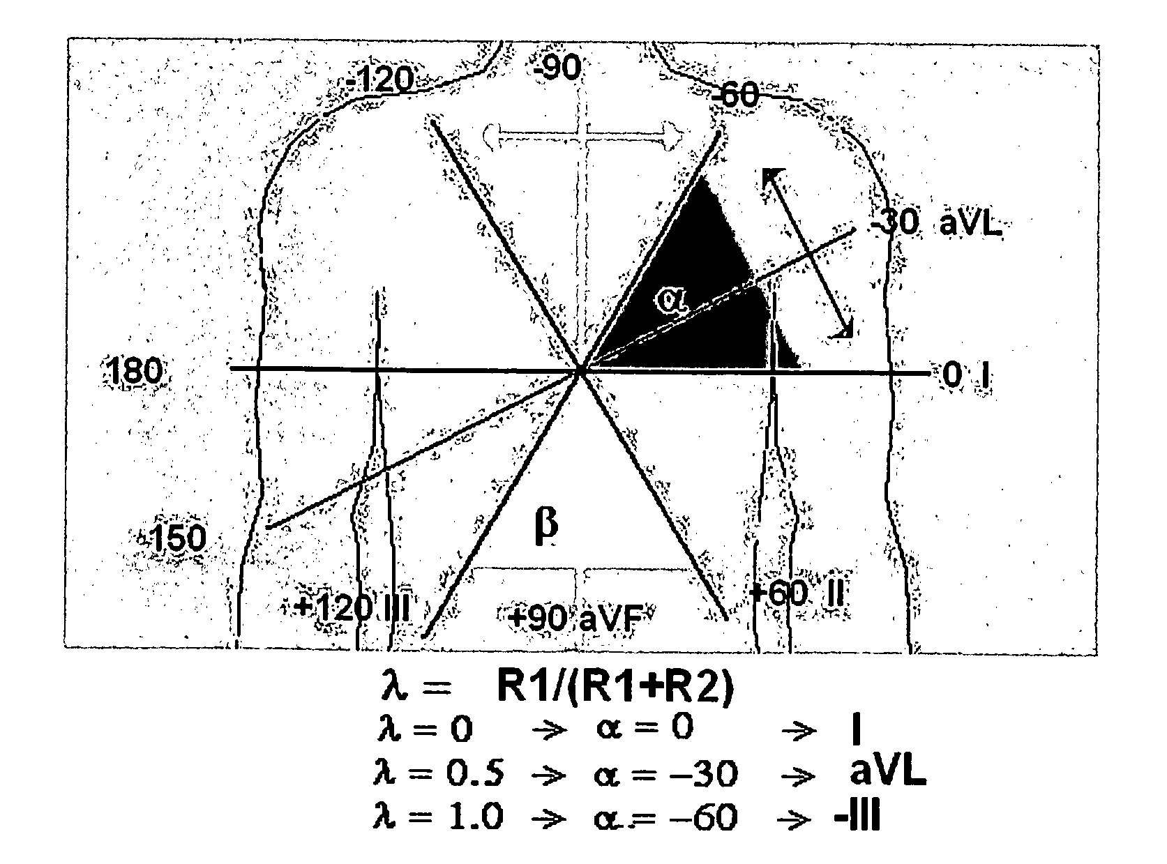 Diagnostic method utilizing standard lead ECG signals