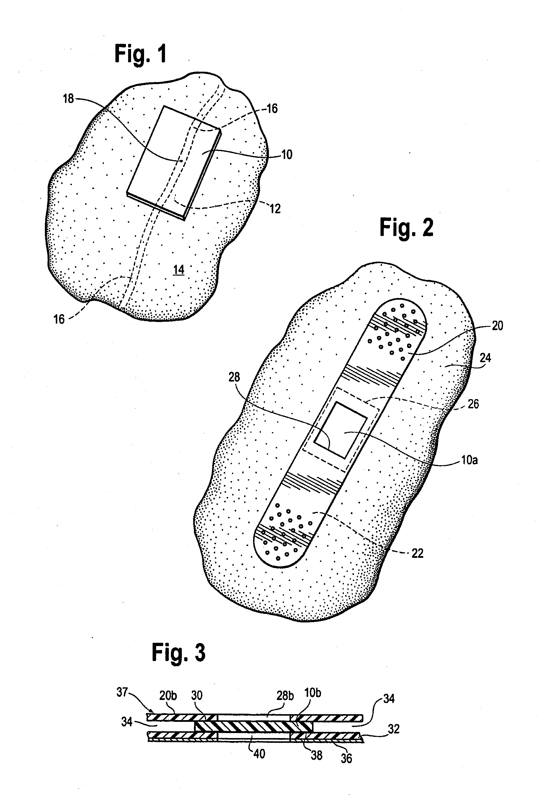 Injection and hemostasis site