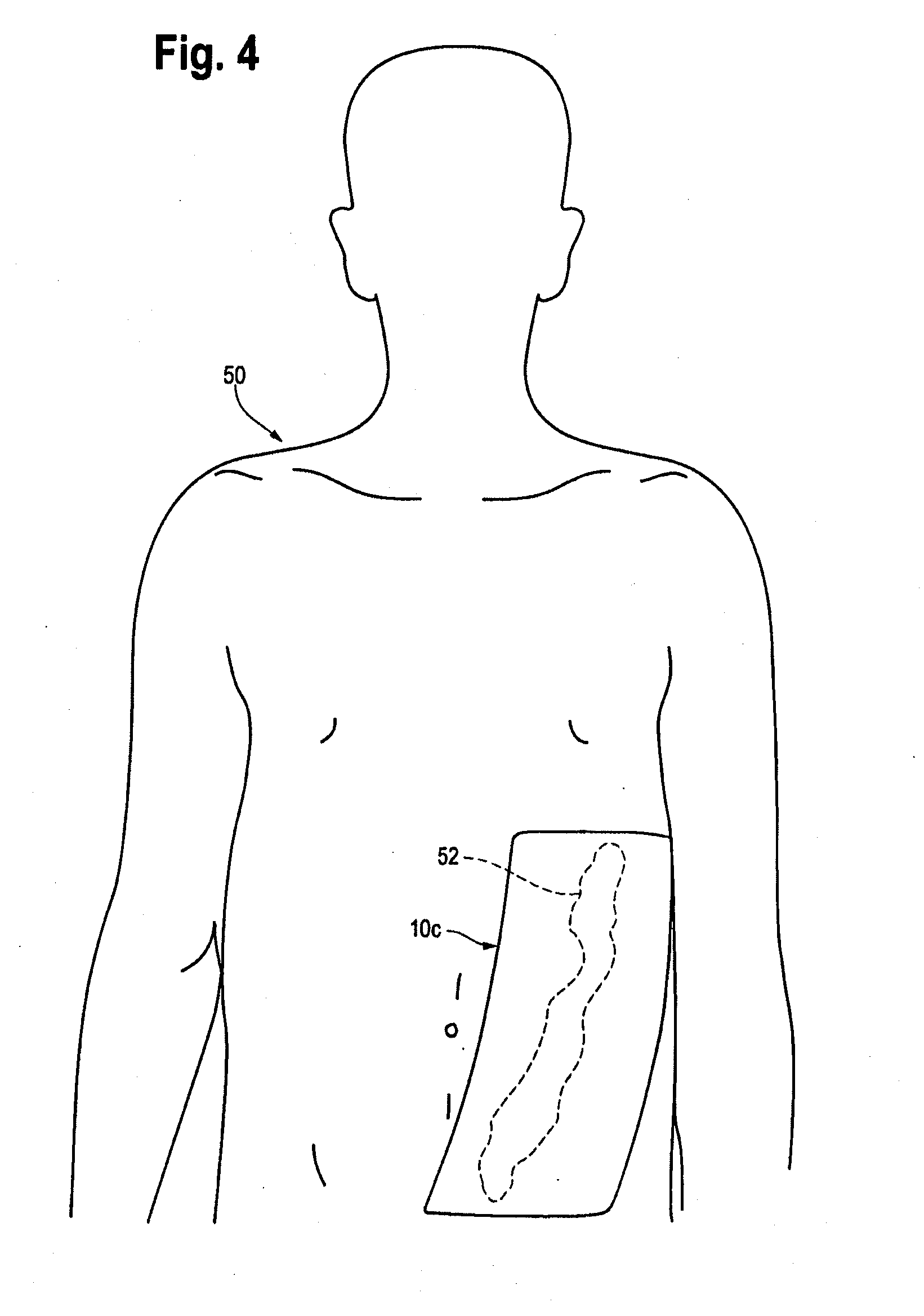 Injection and hemostasis site