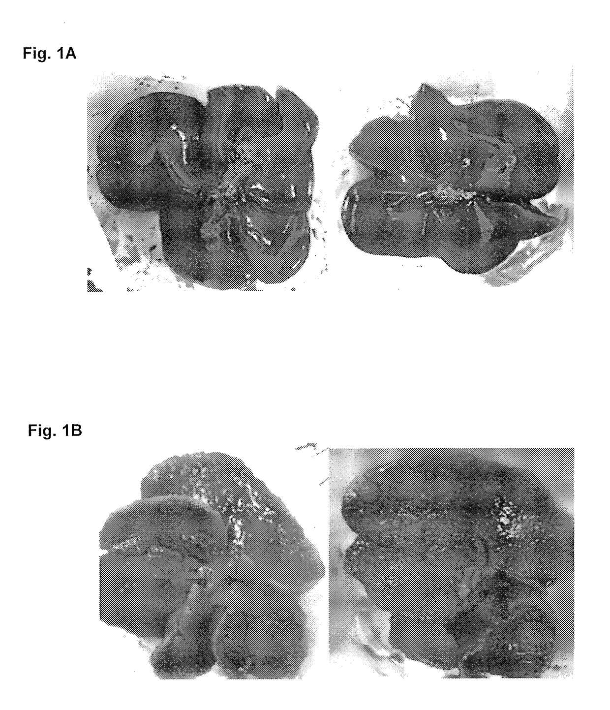 Treatment for hepatic fibrosis