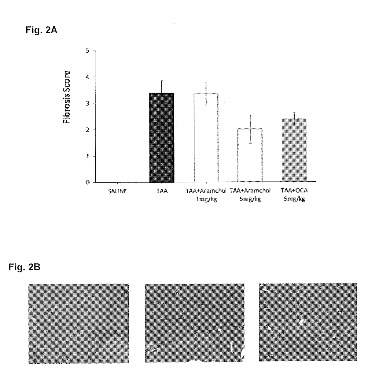 Treatment for hepatic fibrosis