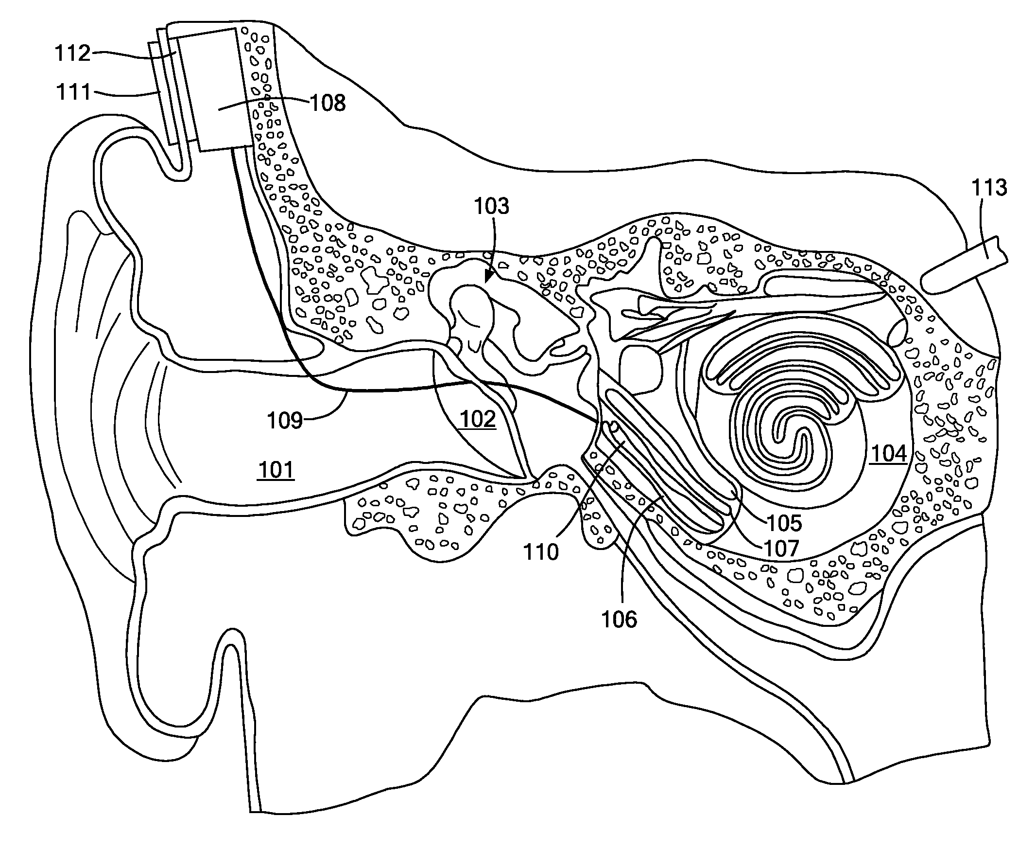 Electrical Nerve Stimulation with Broad Band Low Frequency Filter