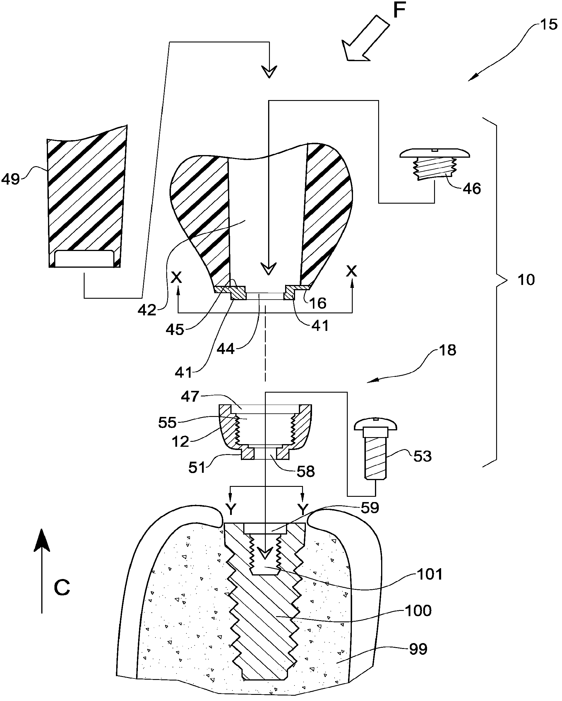 Temporary dental prosthesis