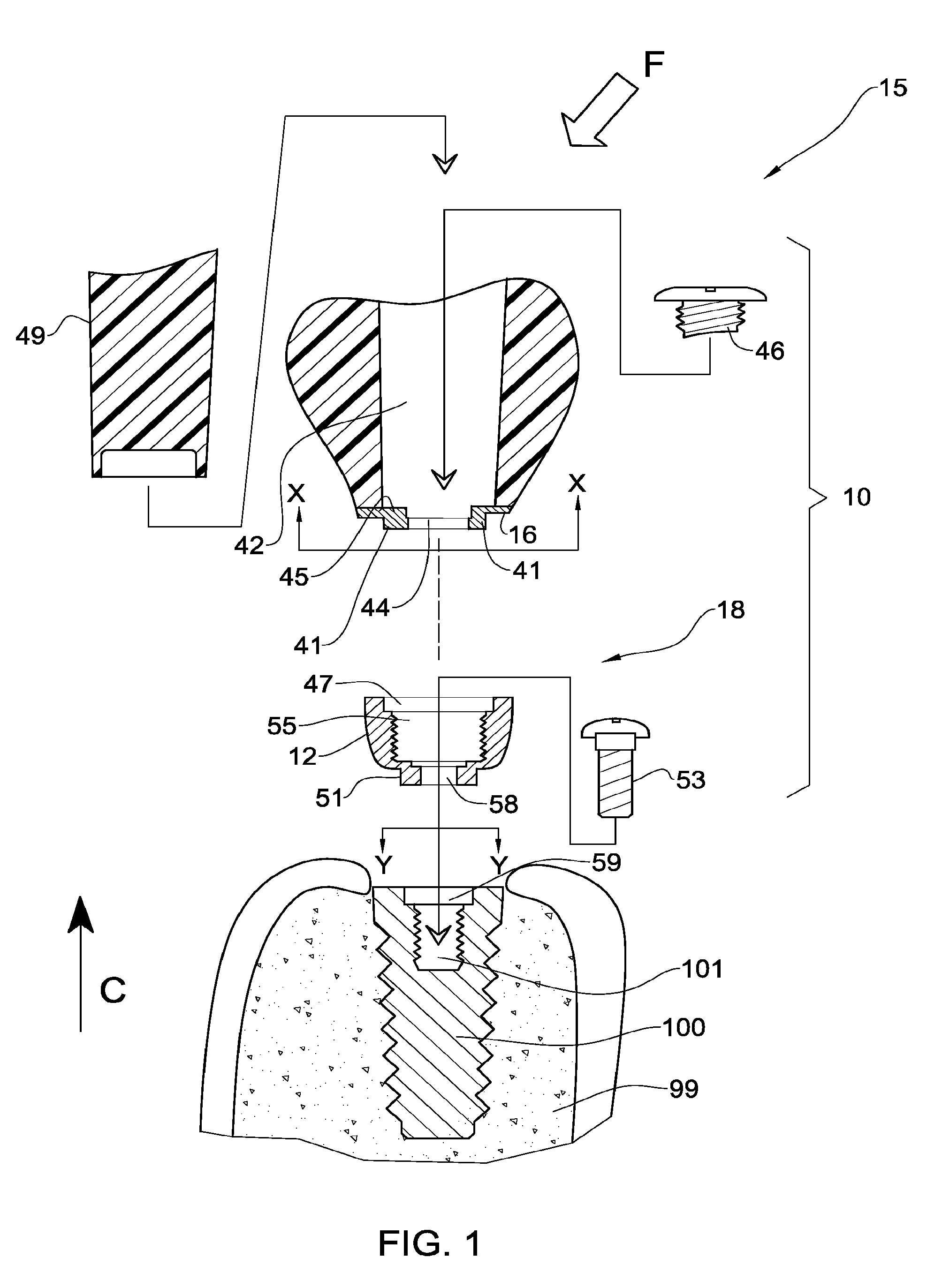 Temporary dental prosthesis