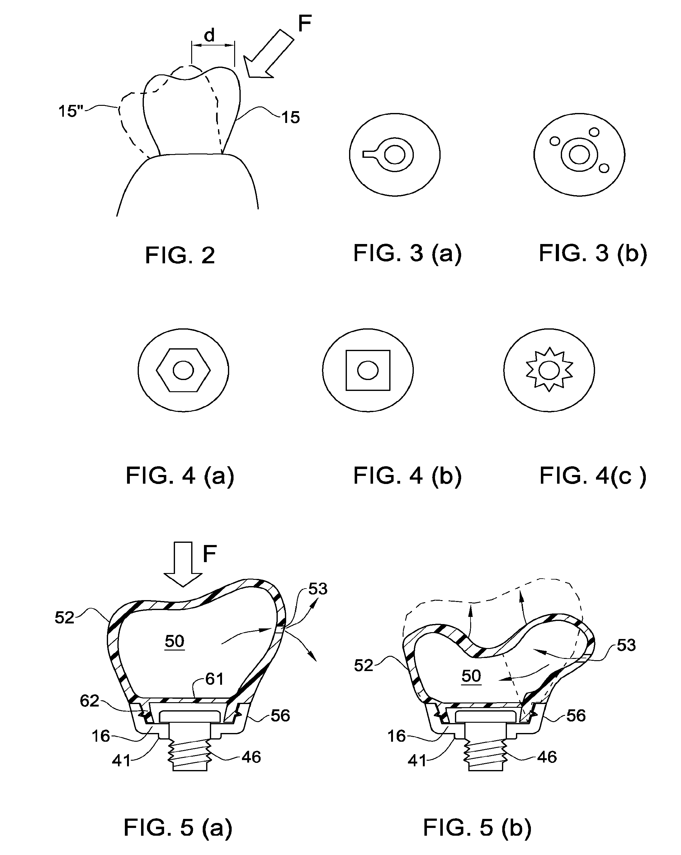 Temporary dental prosthesis