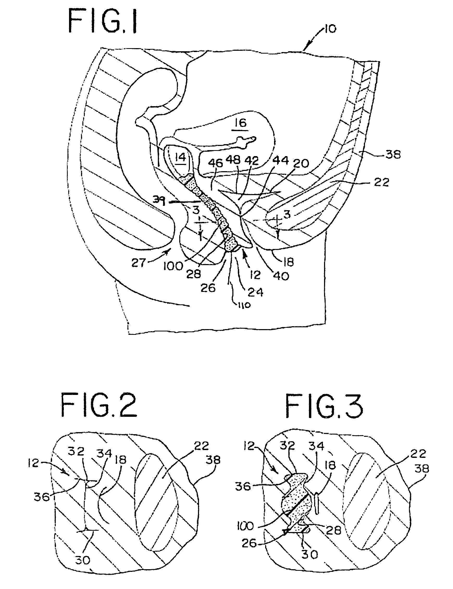 Anatomically conforming vaginal insert