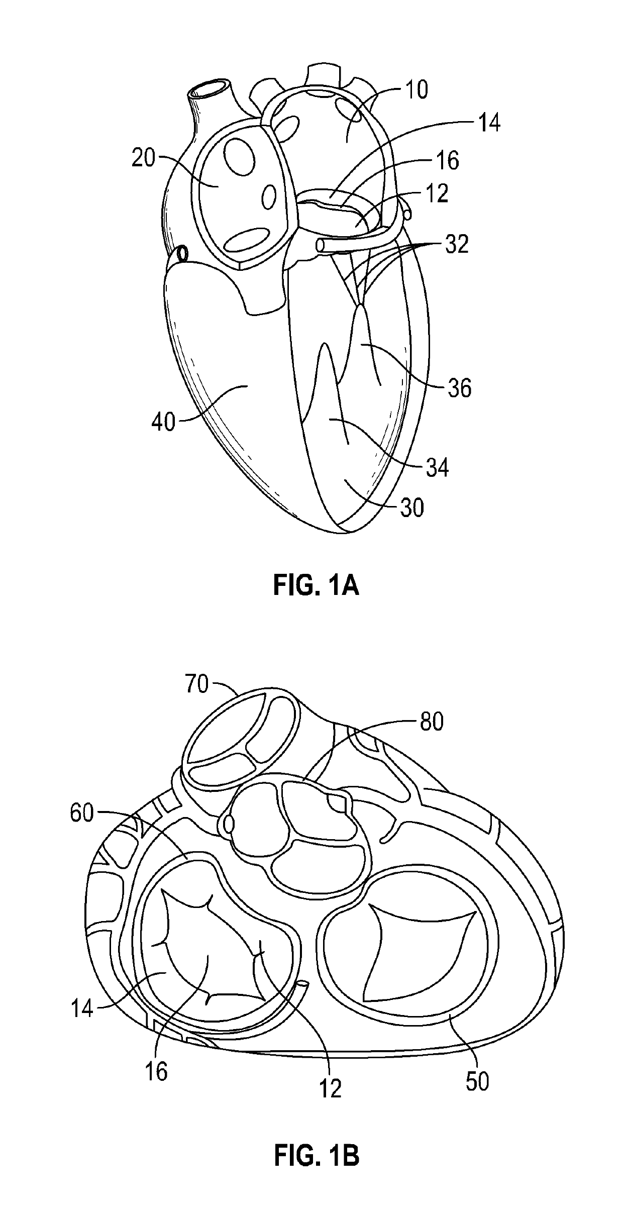 Mitral valve implants for the treatment of valvular regurgitation