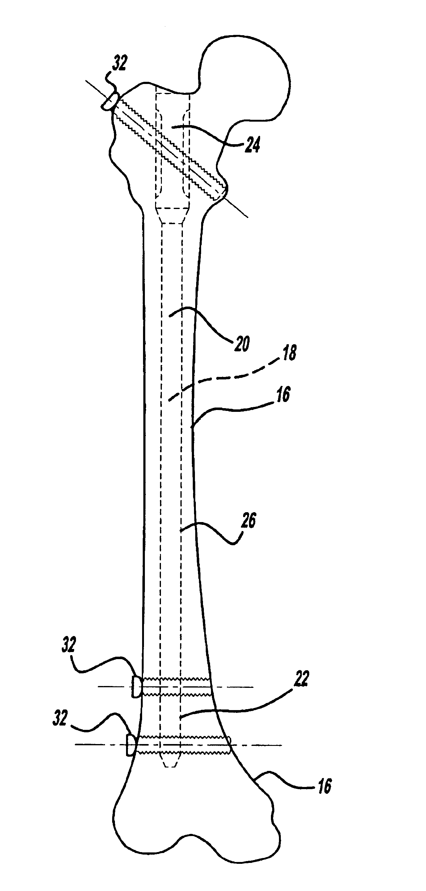 Modular intramedullary nail