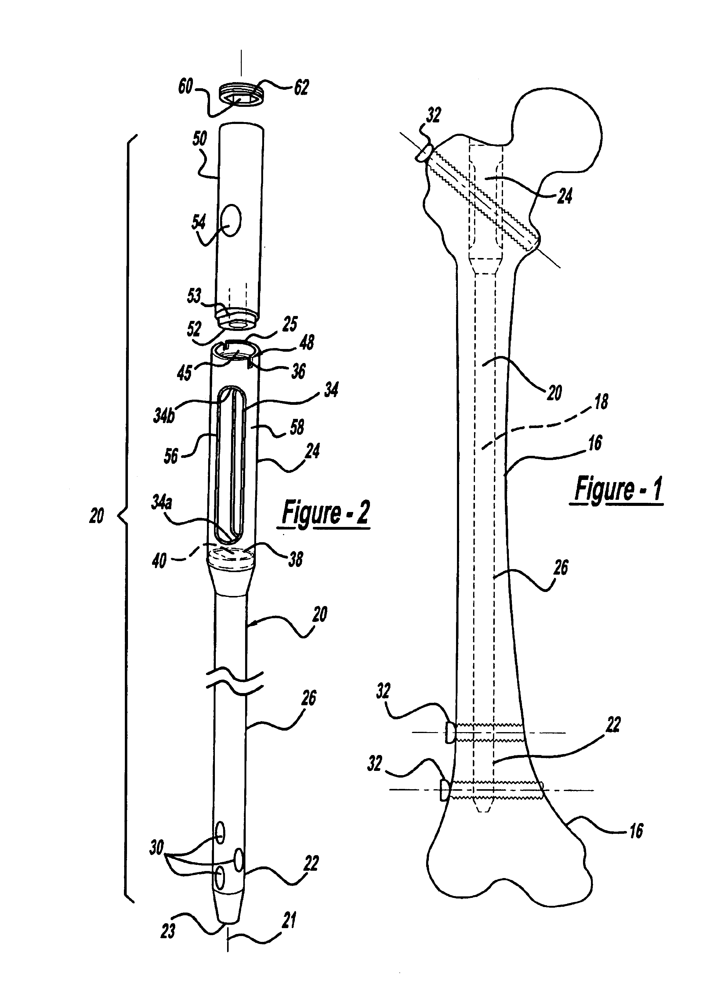 Modular intramedullary nail