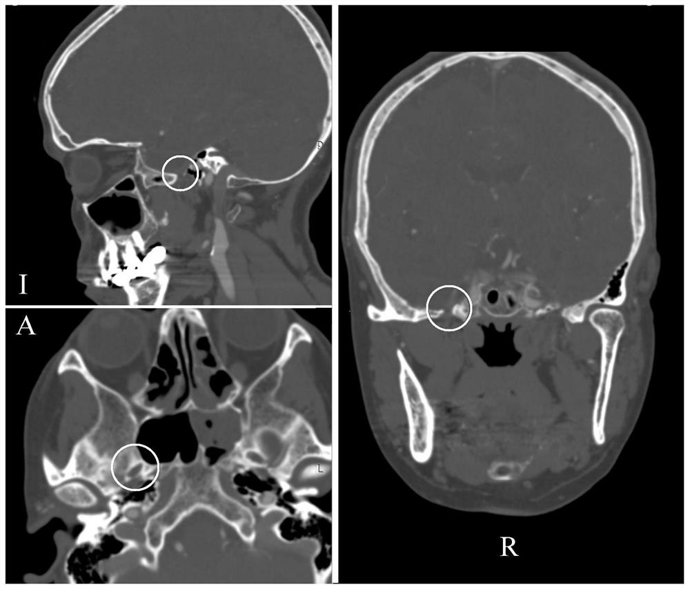 A kind of foramen ovale positioning method, device and storage medium