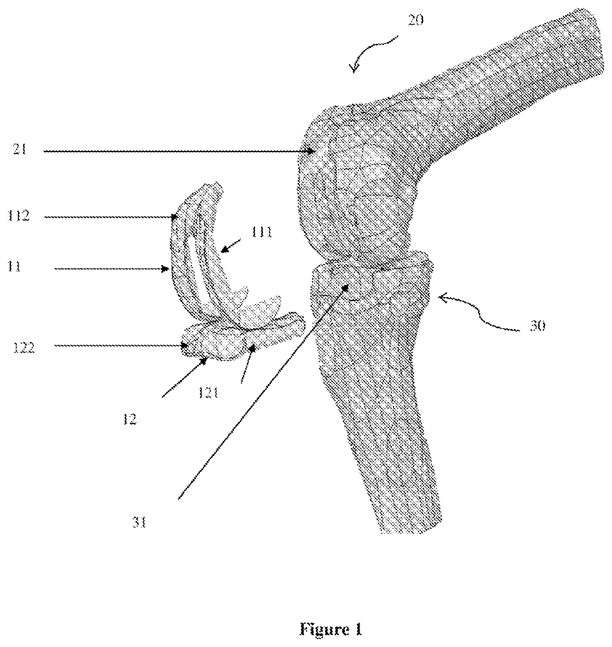 Method for producing a tailor-made implant