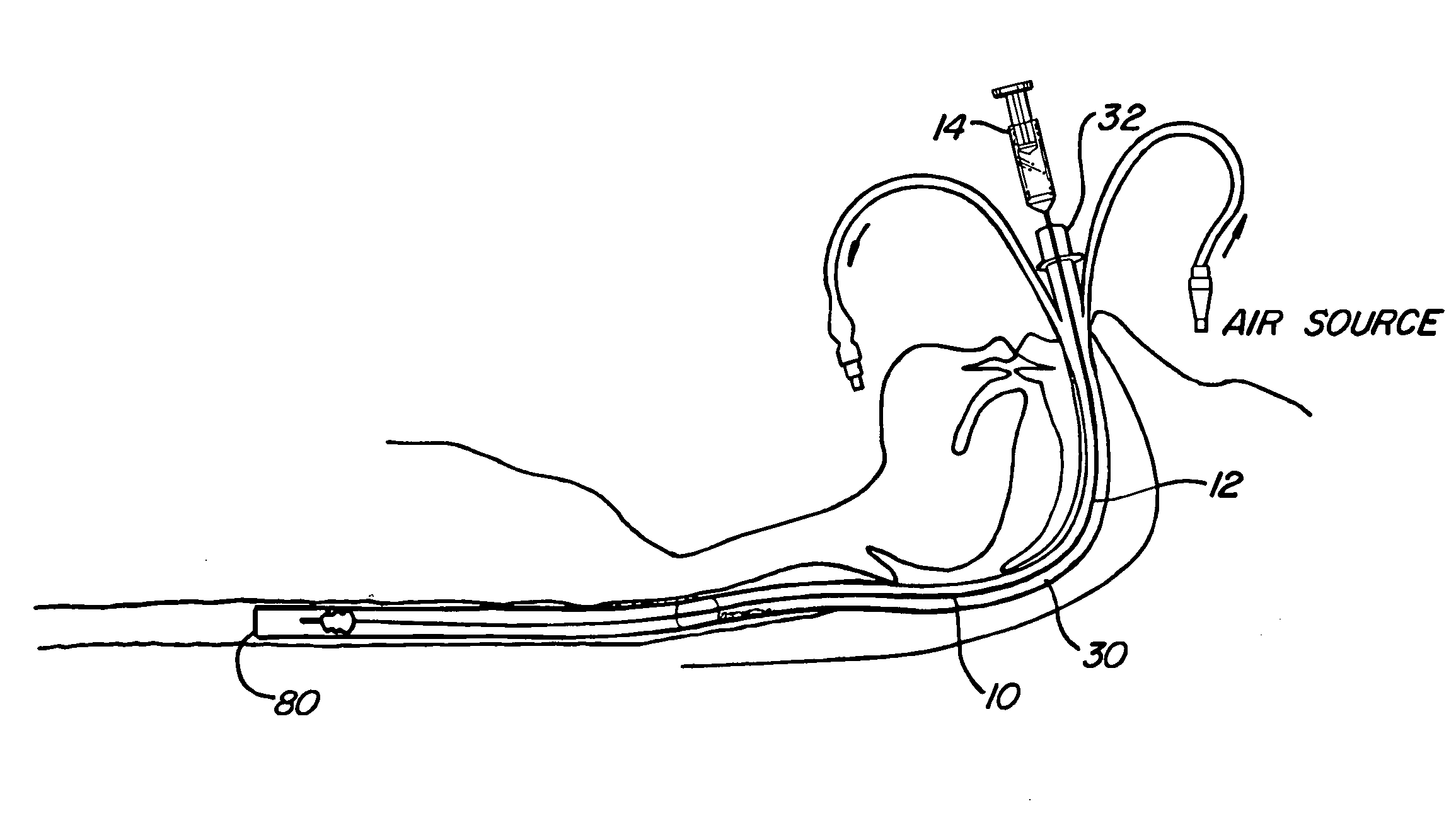 Mucus shaving apparatus for endotracheal tubes