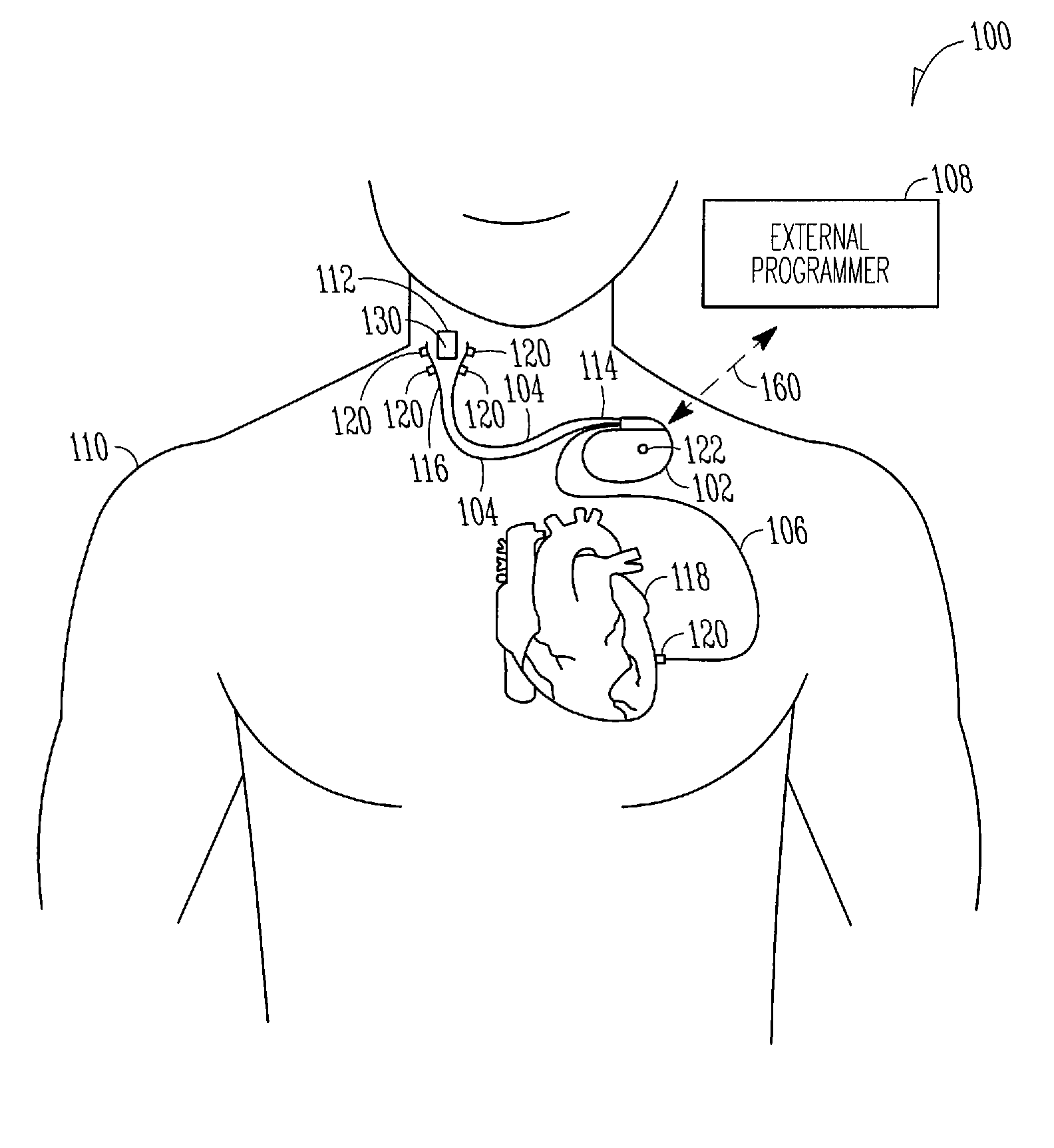 Selective nerve stimulation with optionally closed-loop capabilities