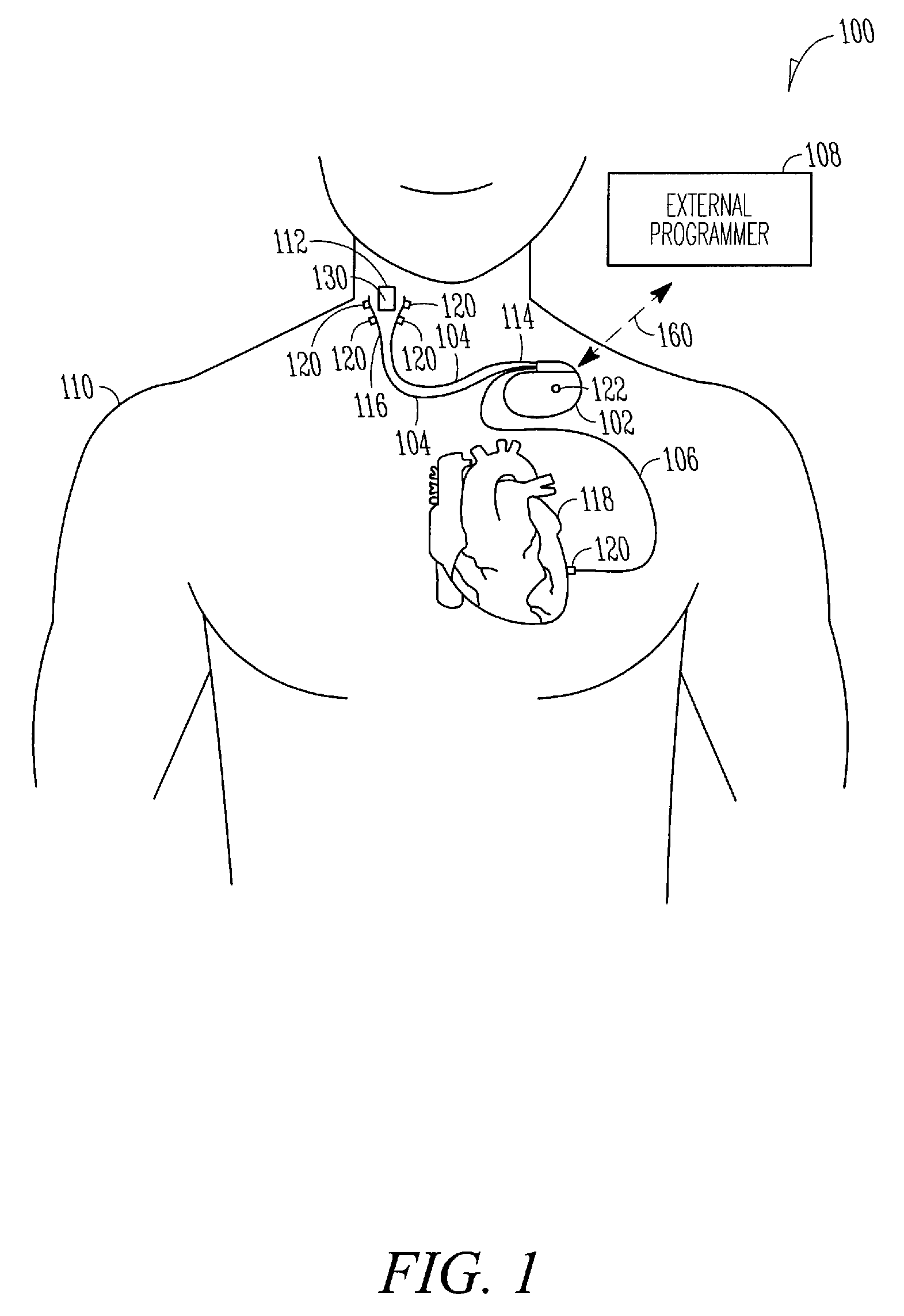 Selective nerve stimulation with optionally closed-loop capabilities