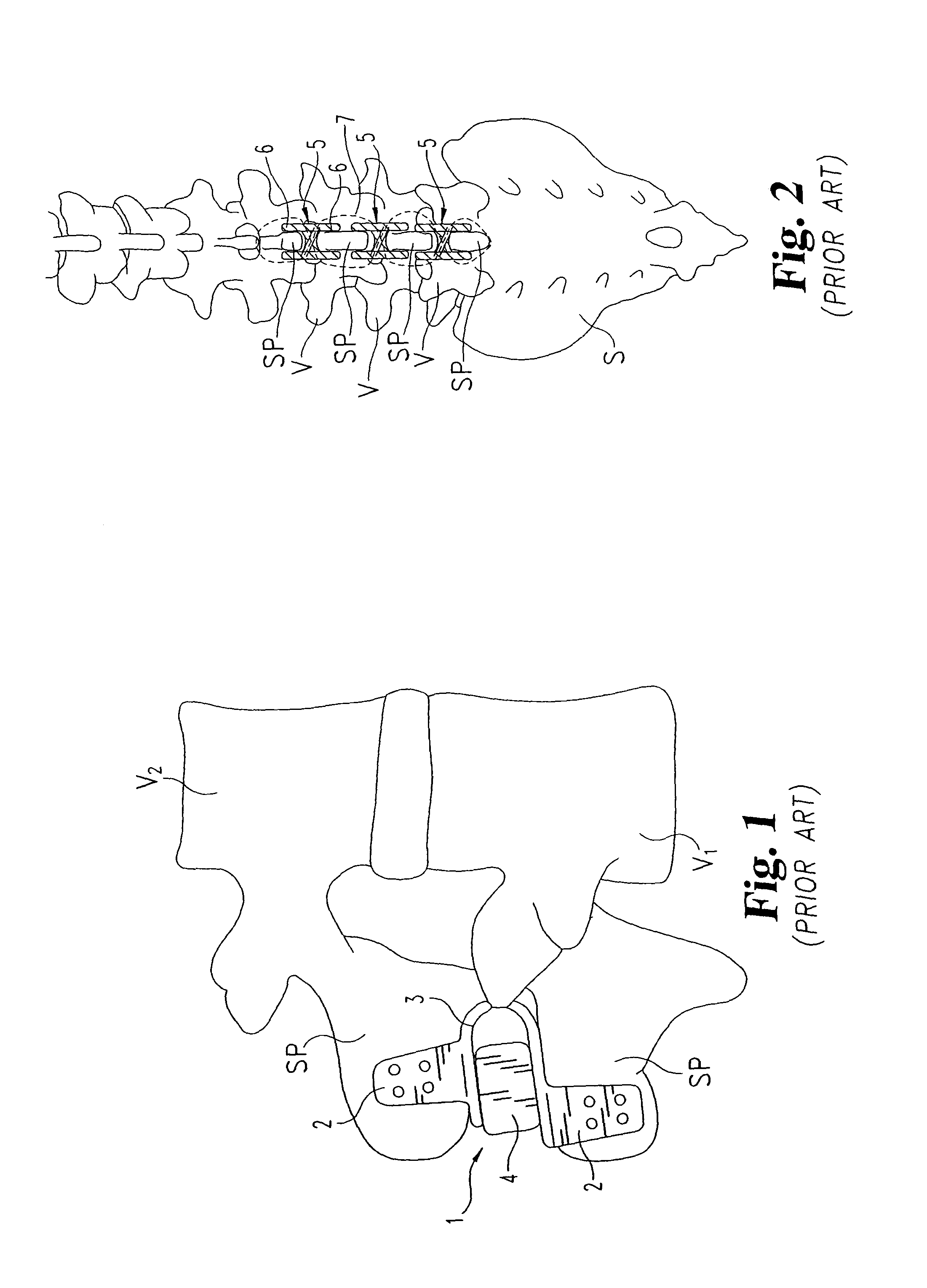 Dynamic stabilization system for the spine