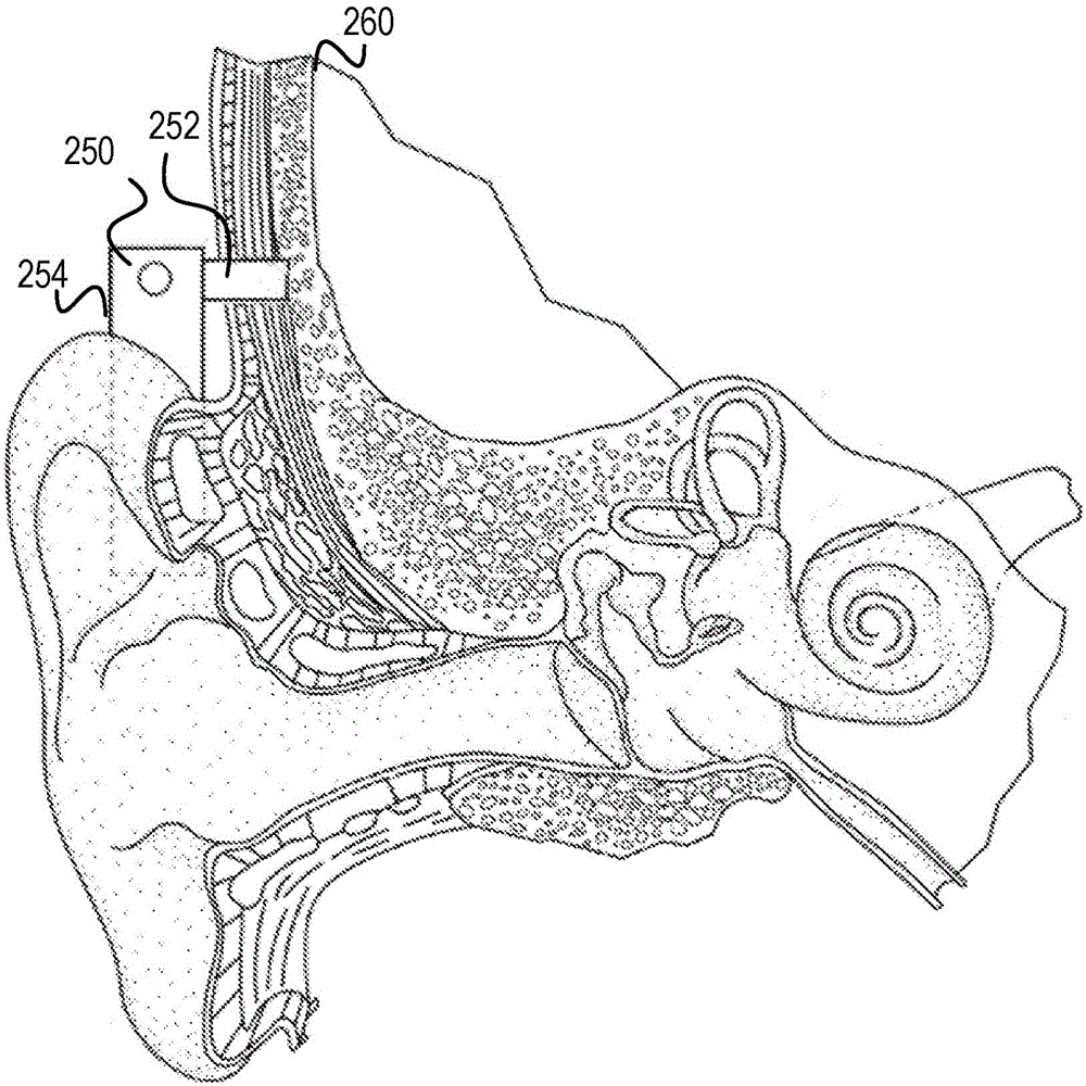 Fitting a bilateral hearing prosthesis system