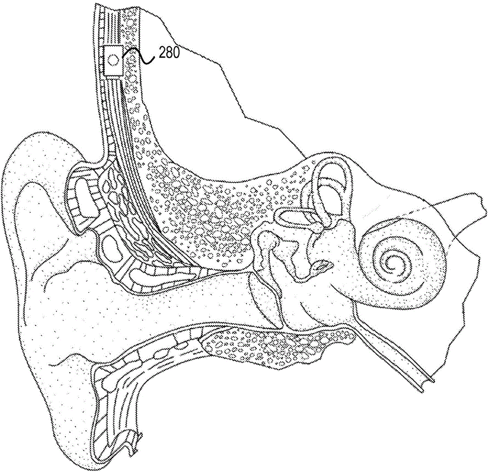 Fitting a bilateral hearing prosthesis system