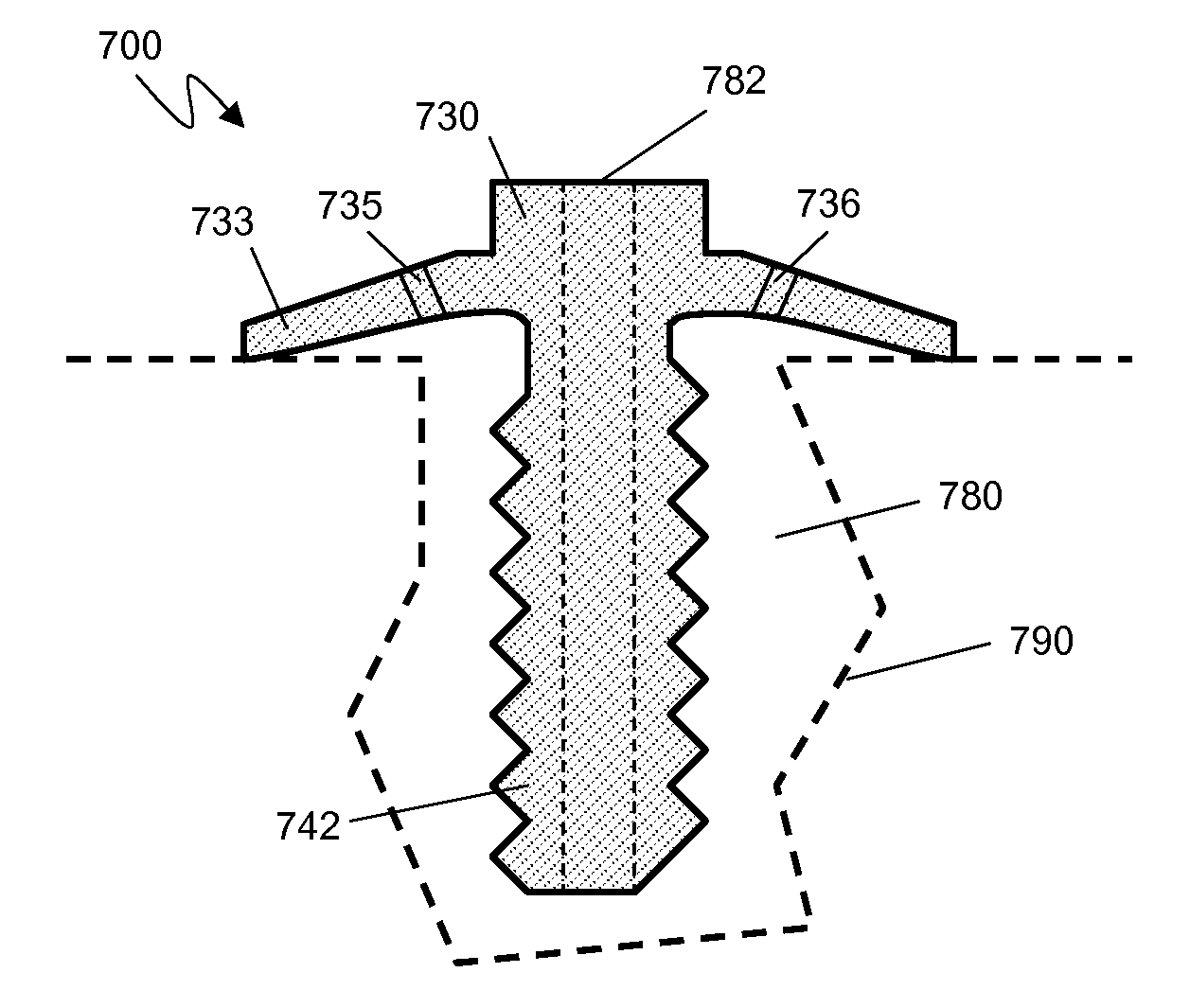 Bone anchors for orthopedic applications