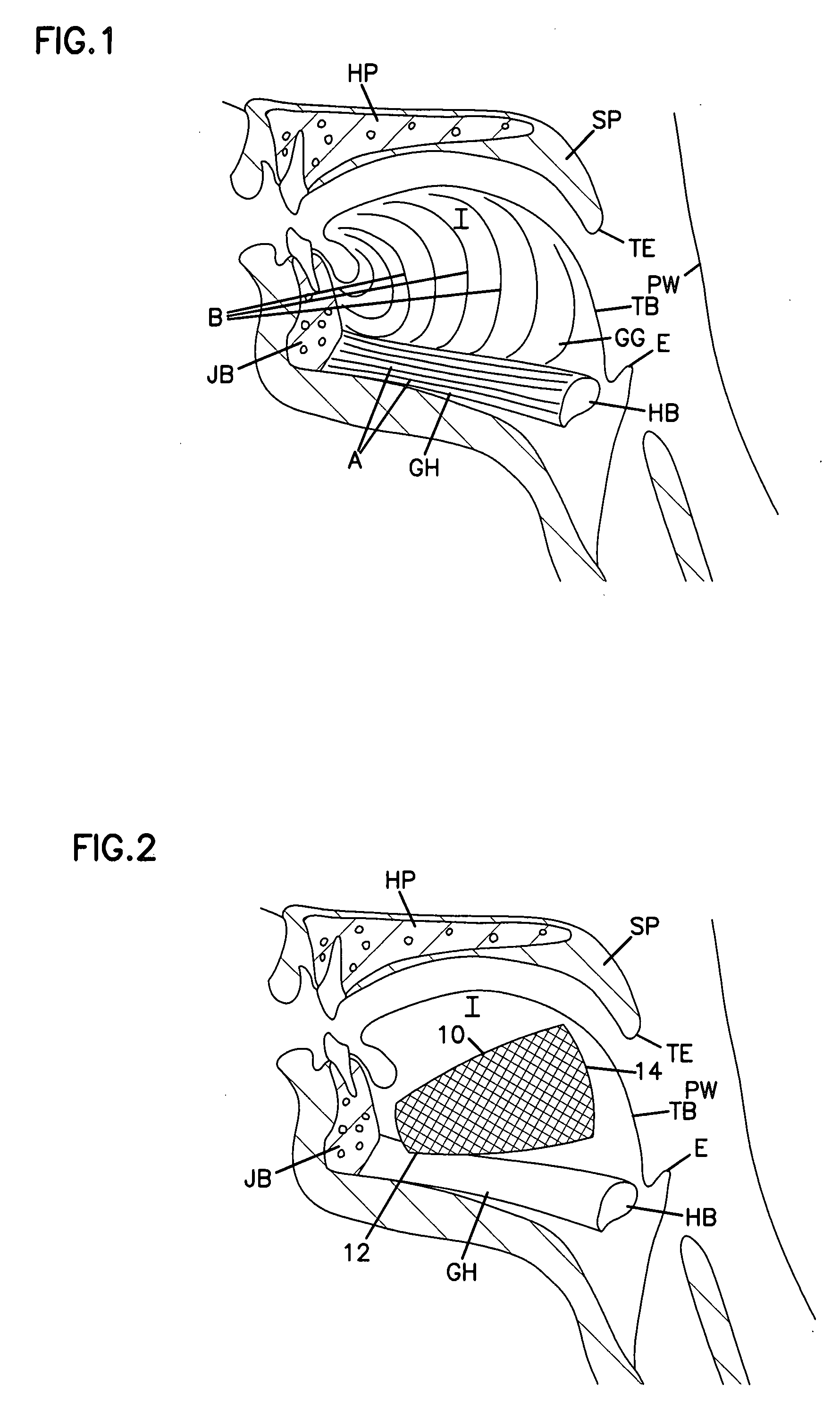 Tongue implant