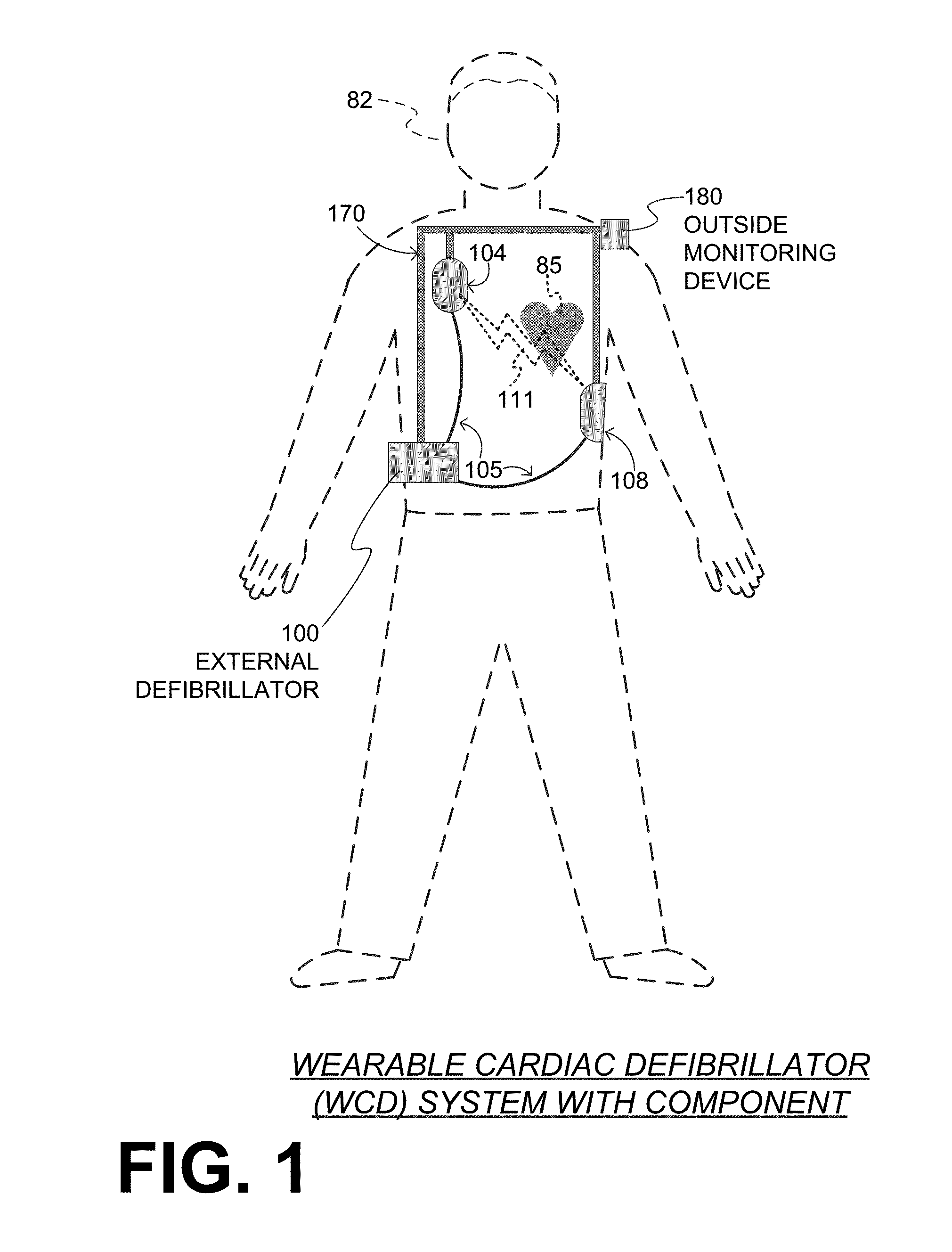 Wearable cardioverter defibrillator components discarding ECG signals prior to making shock/no shock determination