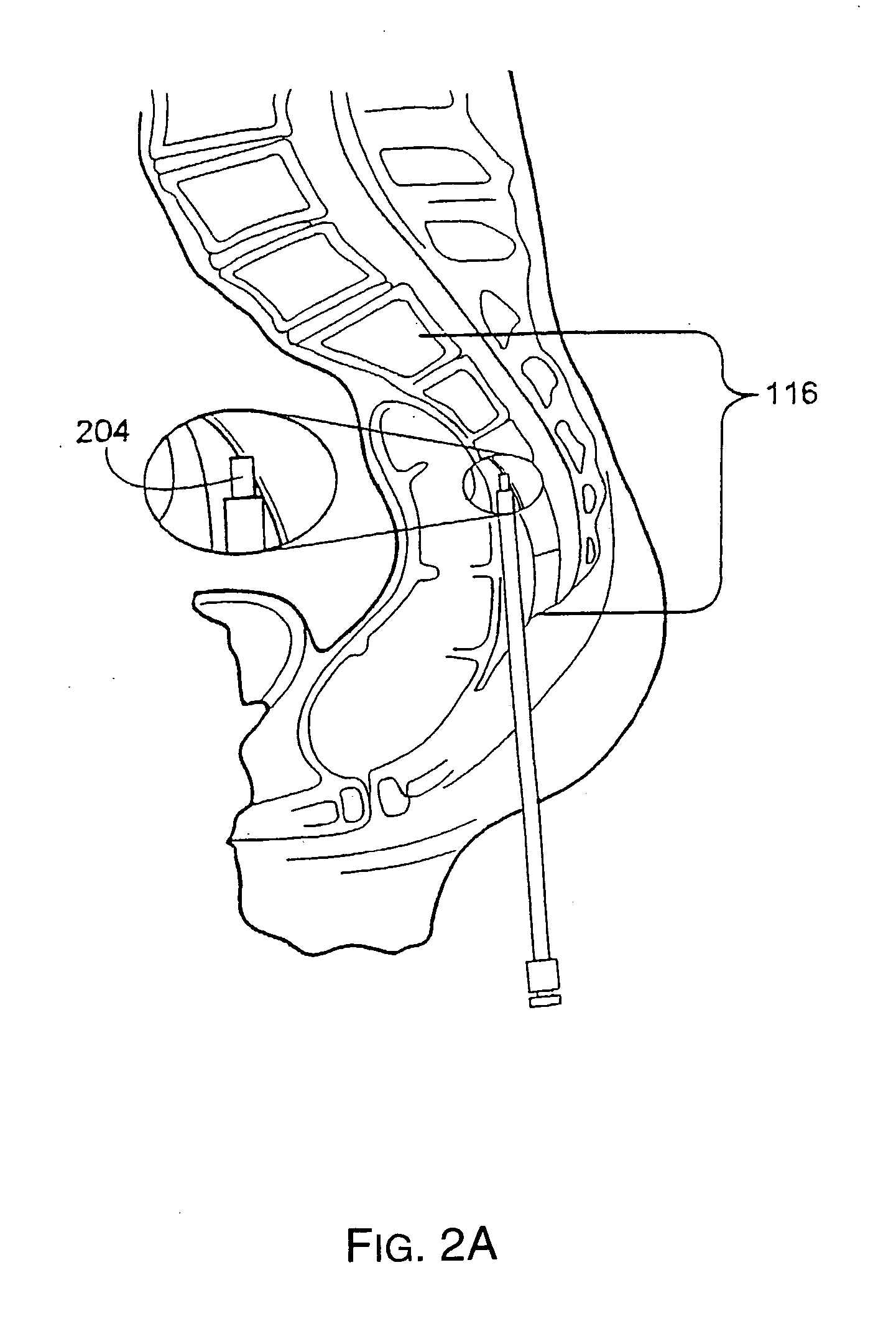 Methods and tools for delivery of spinal motion preservation assemblies