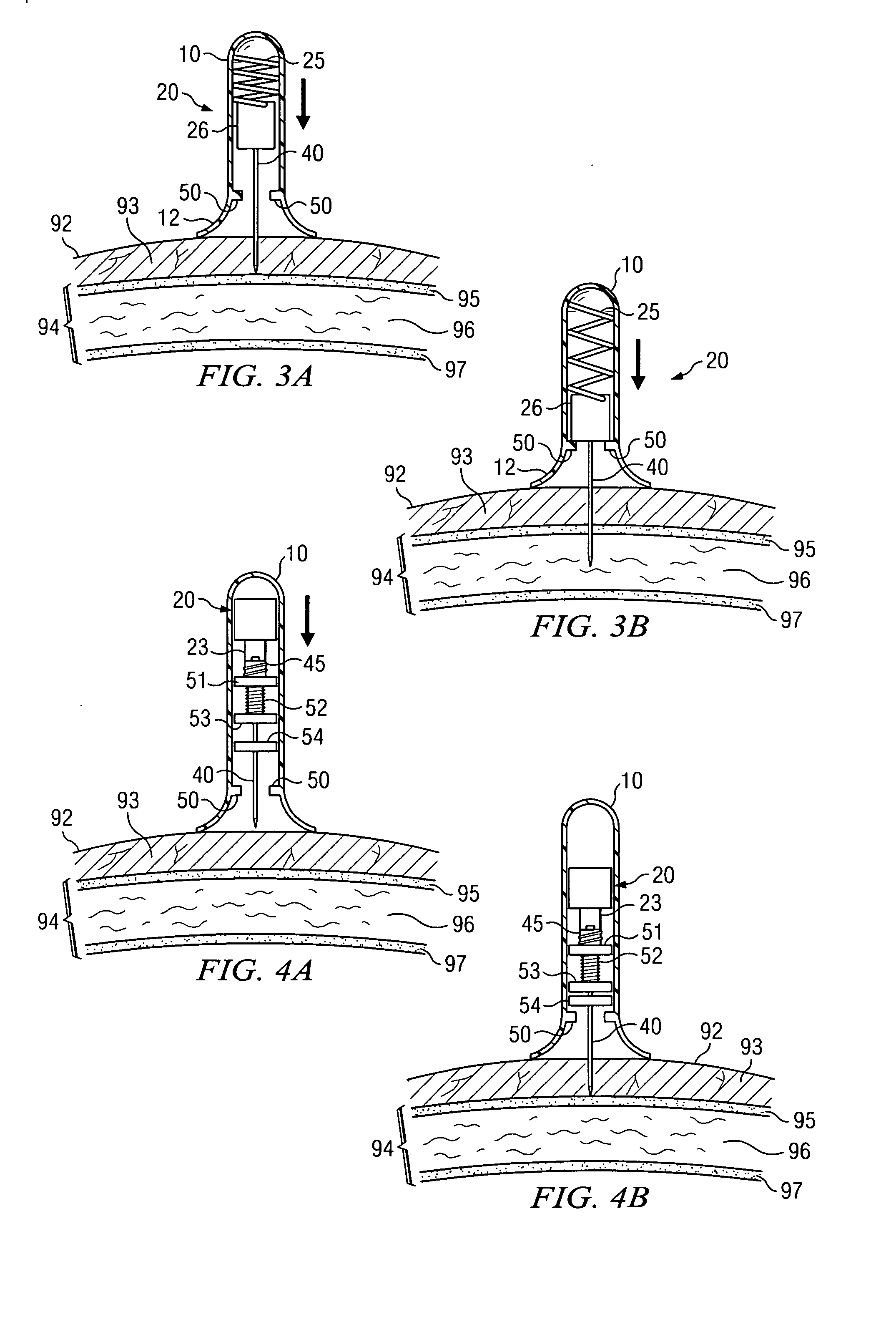 Apparatus and method for accessing the bone marrow of the sternum