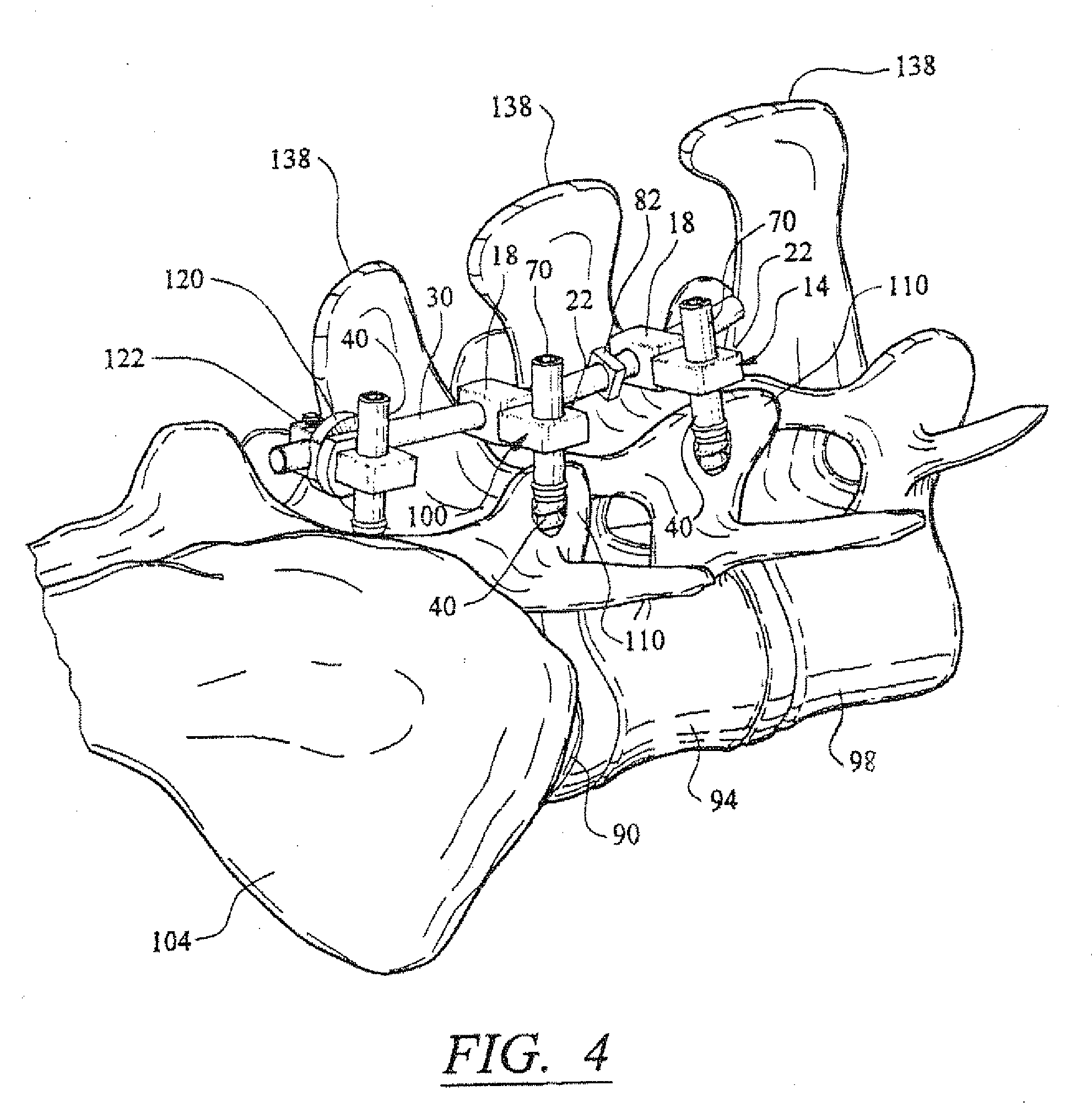 Artificial facet joint and method