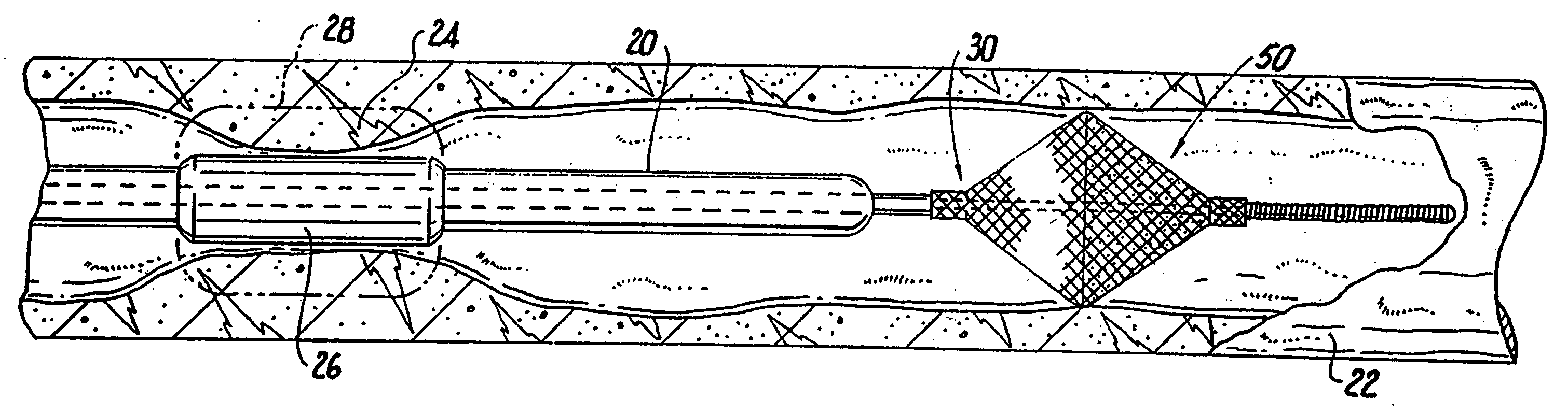 Temporary vascular filter, guide wire