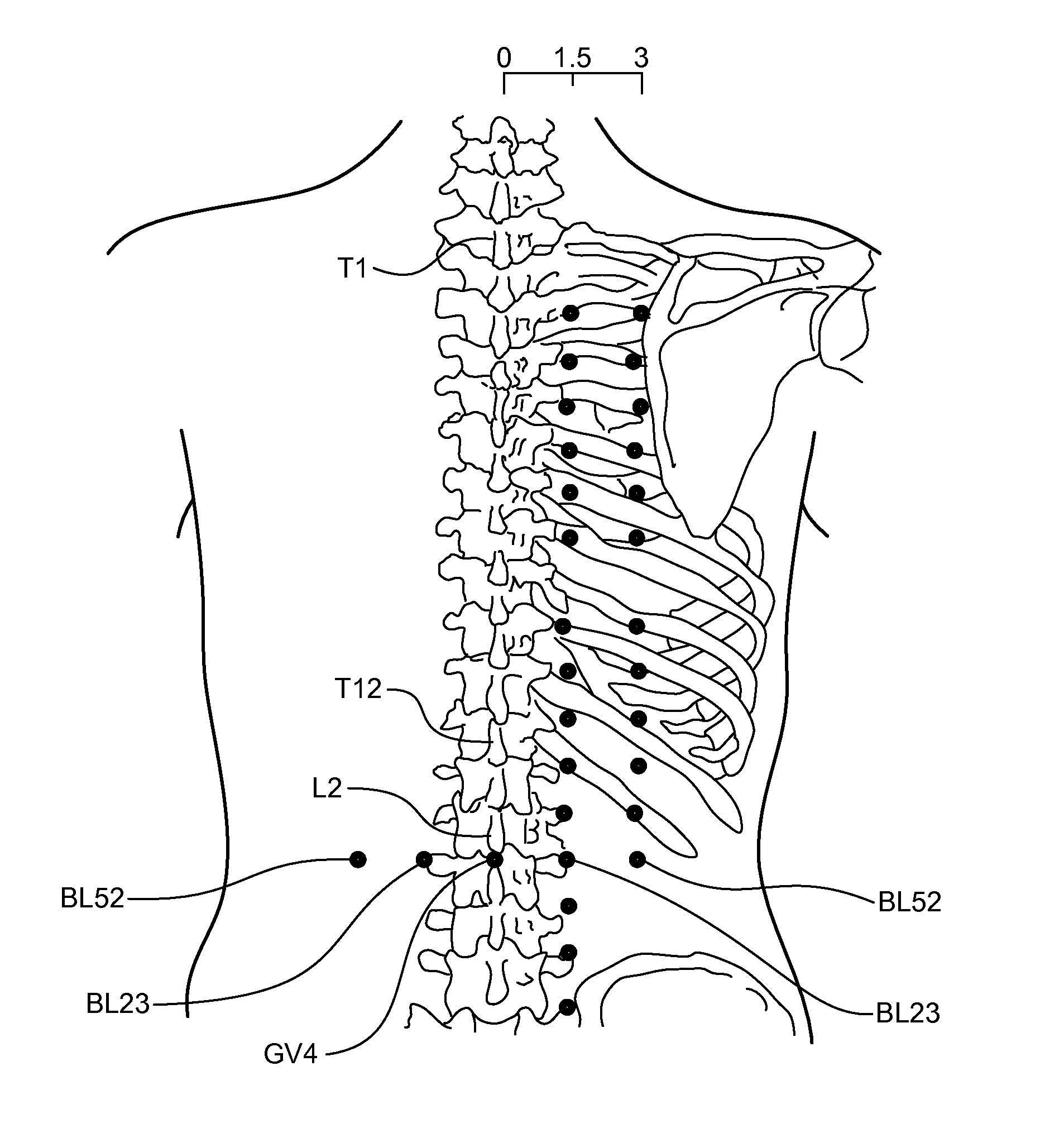 Methods and Systems for Treating a Chronic Low Back Pain Condition Using an Implantable Electroacupuncture Device