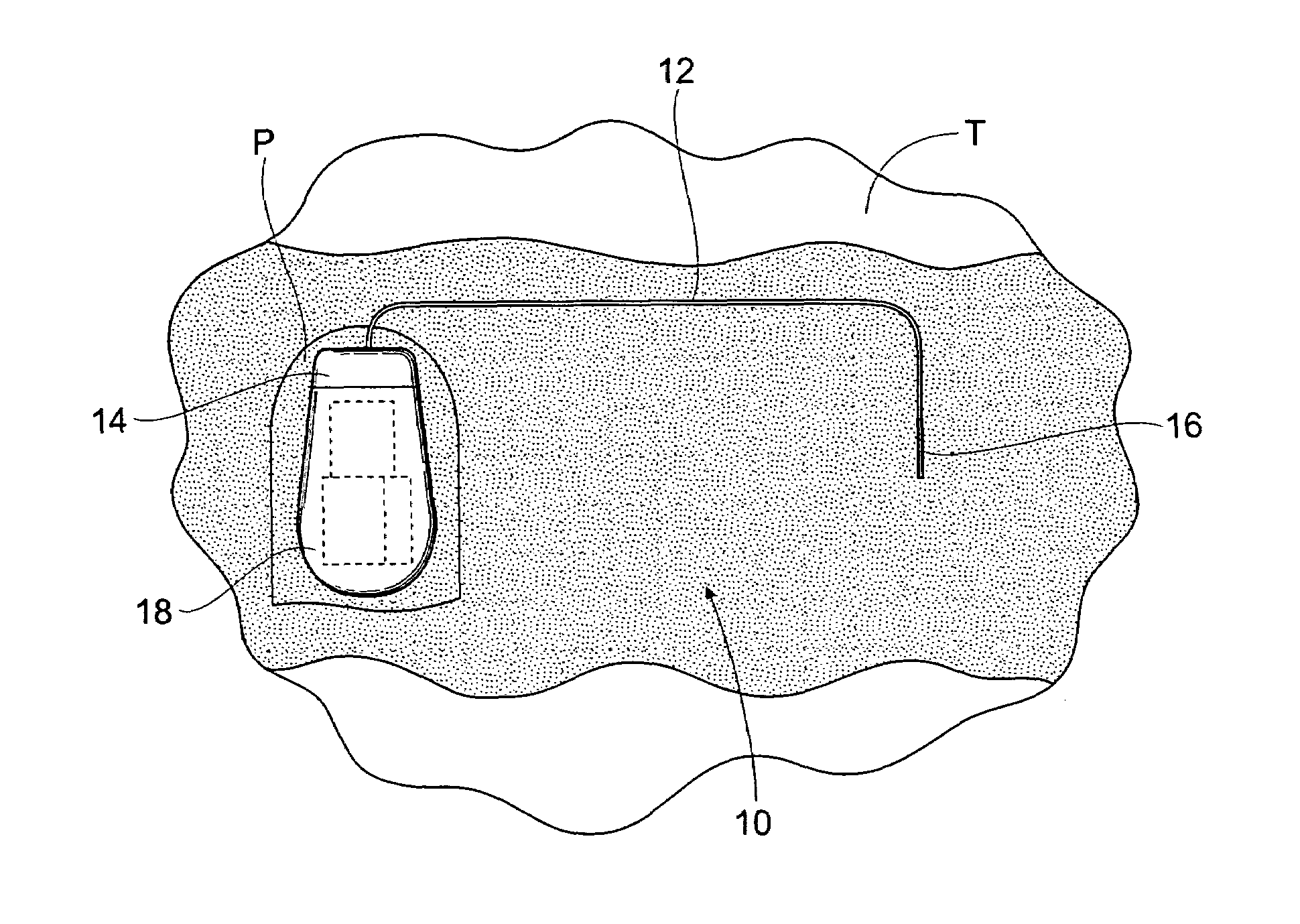 Implantable pulse generator for providing functional and/or therapeutic stimulation of muscles and/or nerves and/or central nervous system tissue