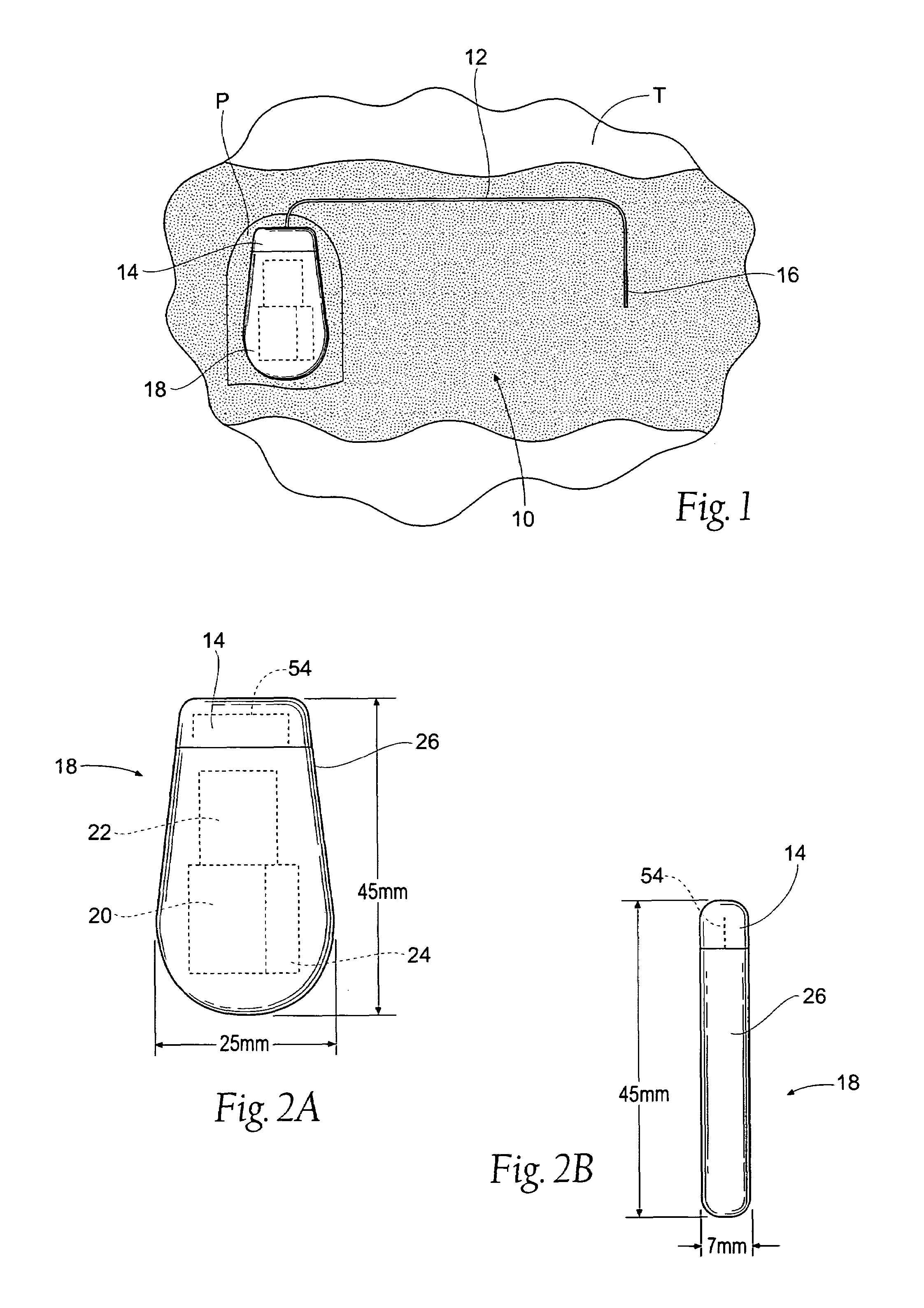 Implantable pulse generator for providing functional and/or therapeutic stimulation of muscles and/or nerves and/or central nervous system tissue