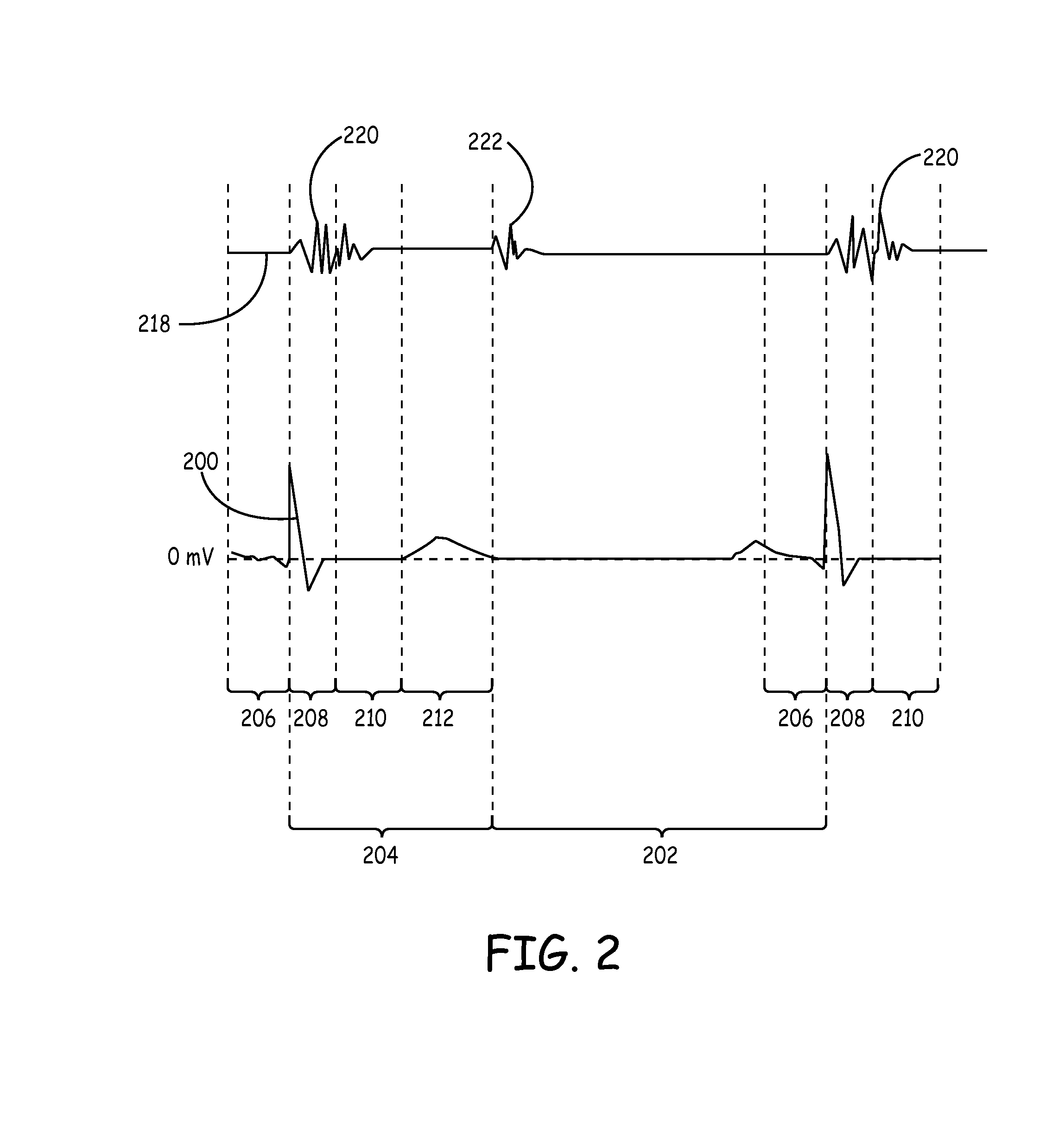 Heart Monitoring Systems, Apparatus and Methods Adapted to Detect Myocardial Ischemia