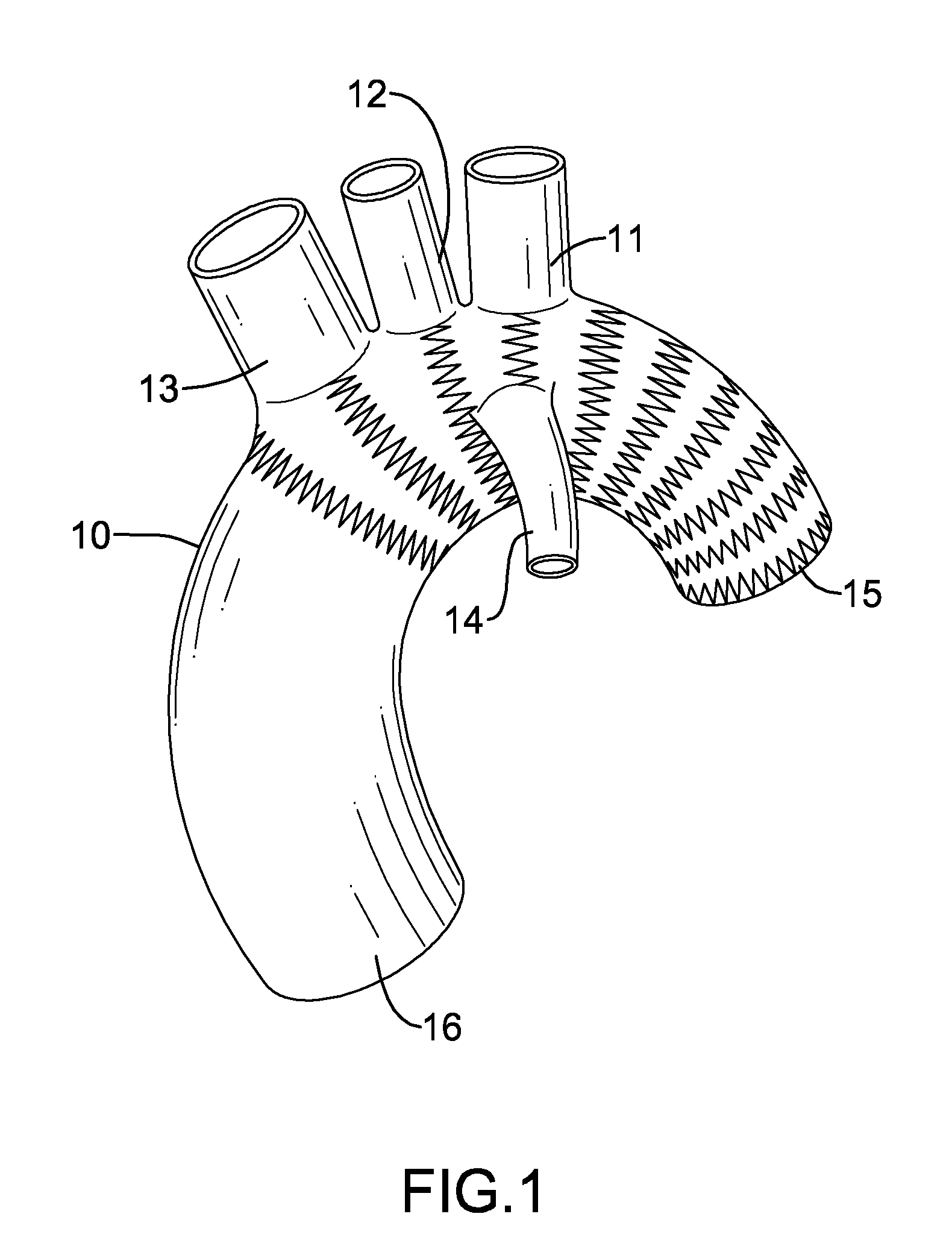 Stent Graft System