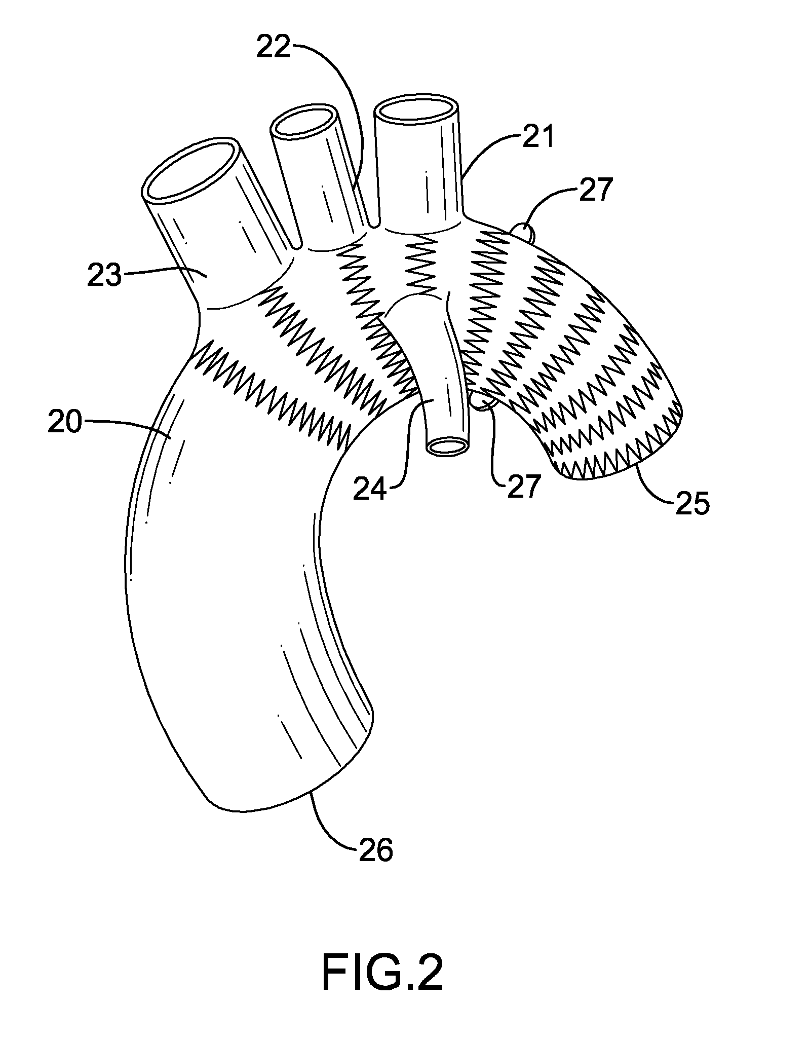 Stent Graft System