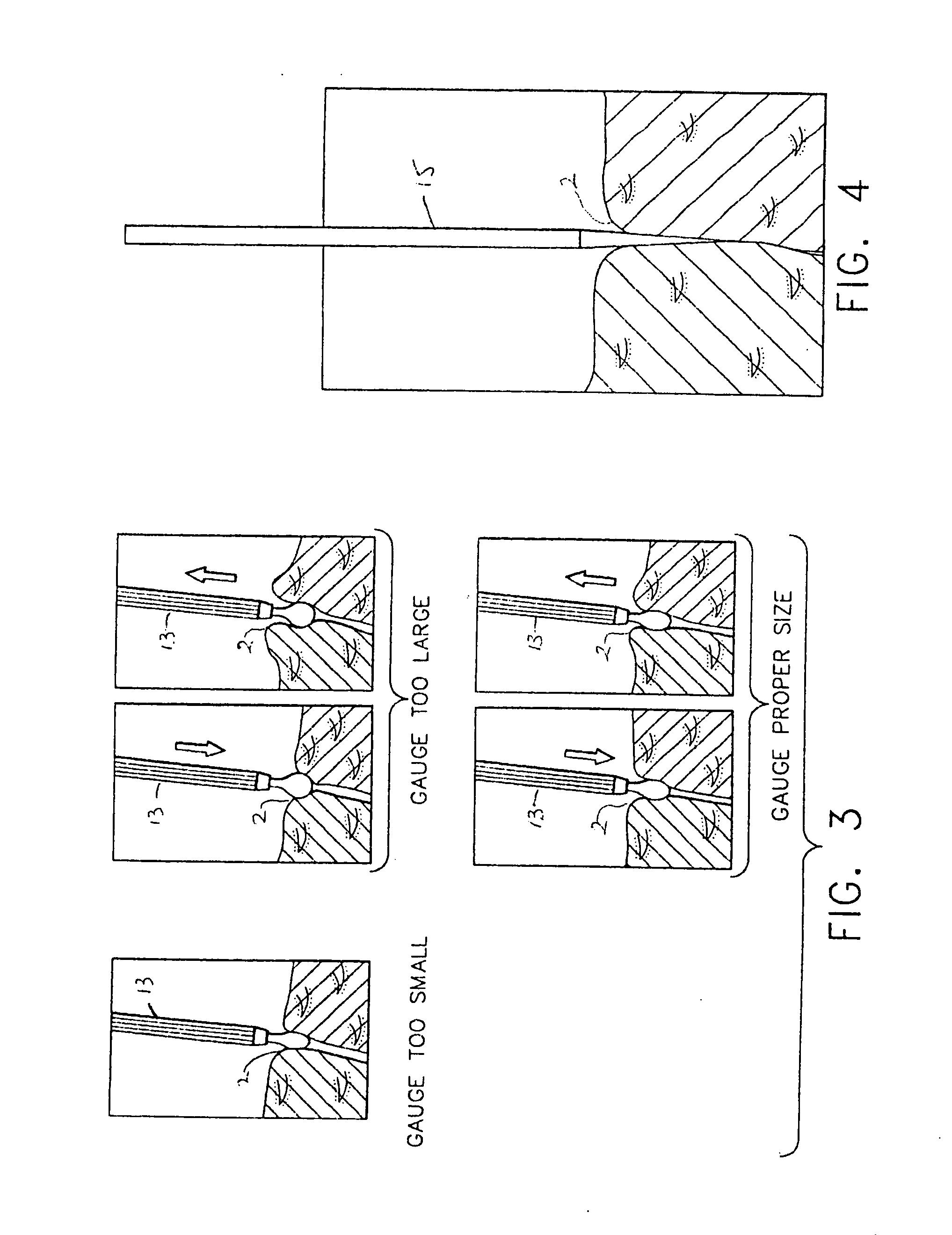 Ocular occluder and method of insertion