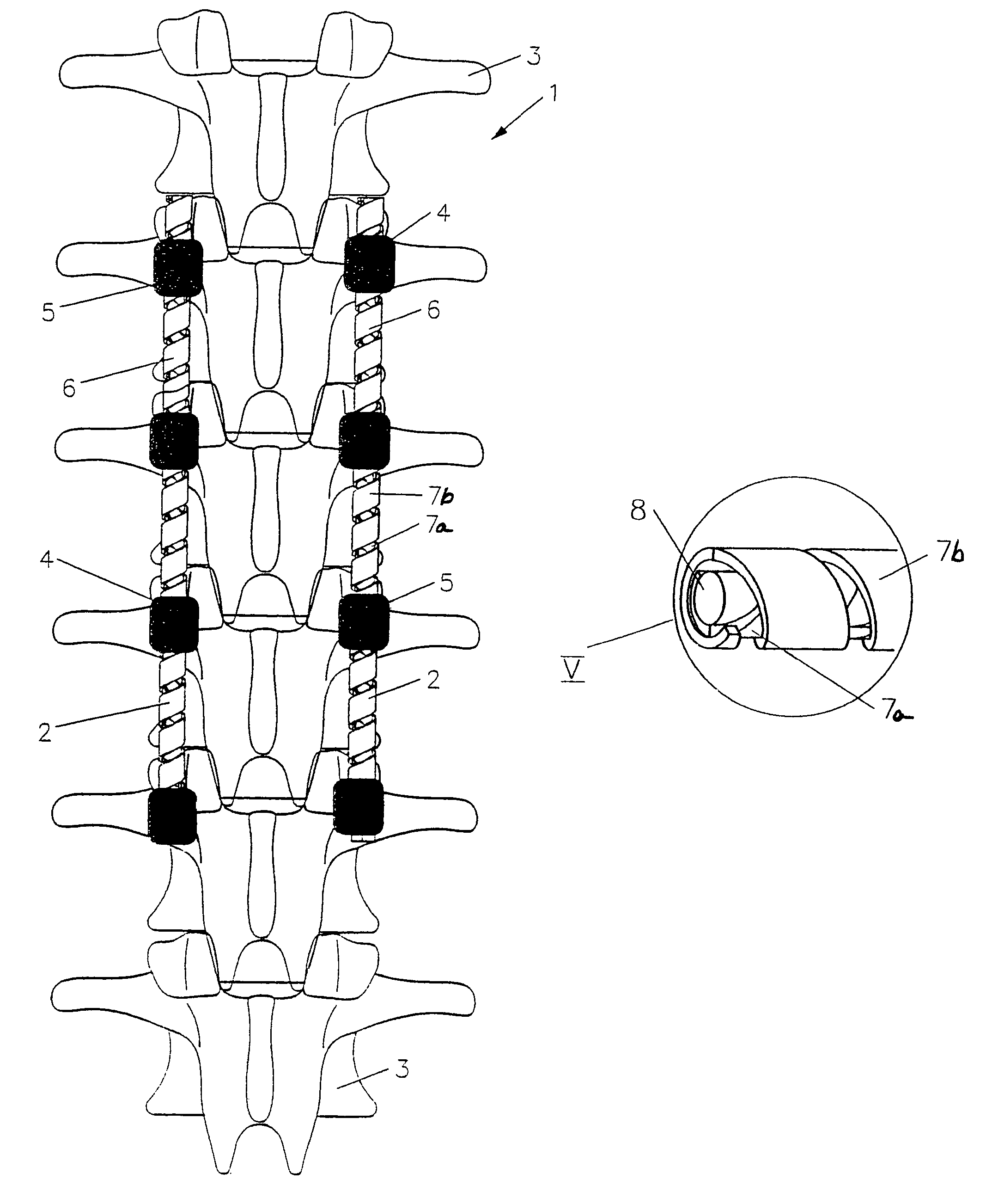 Implant for correction and stabilization of the spinal column