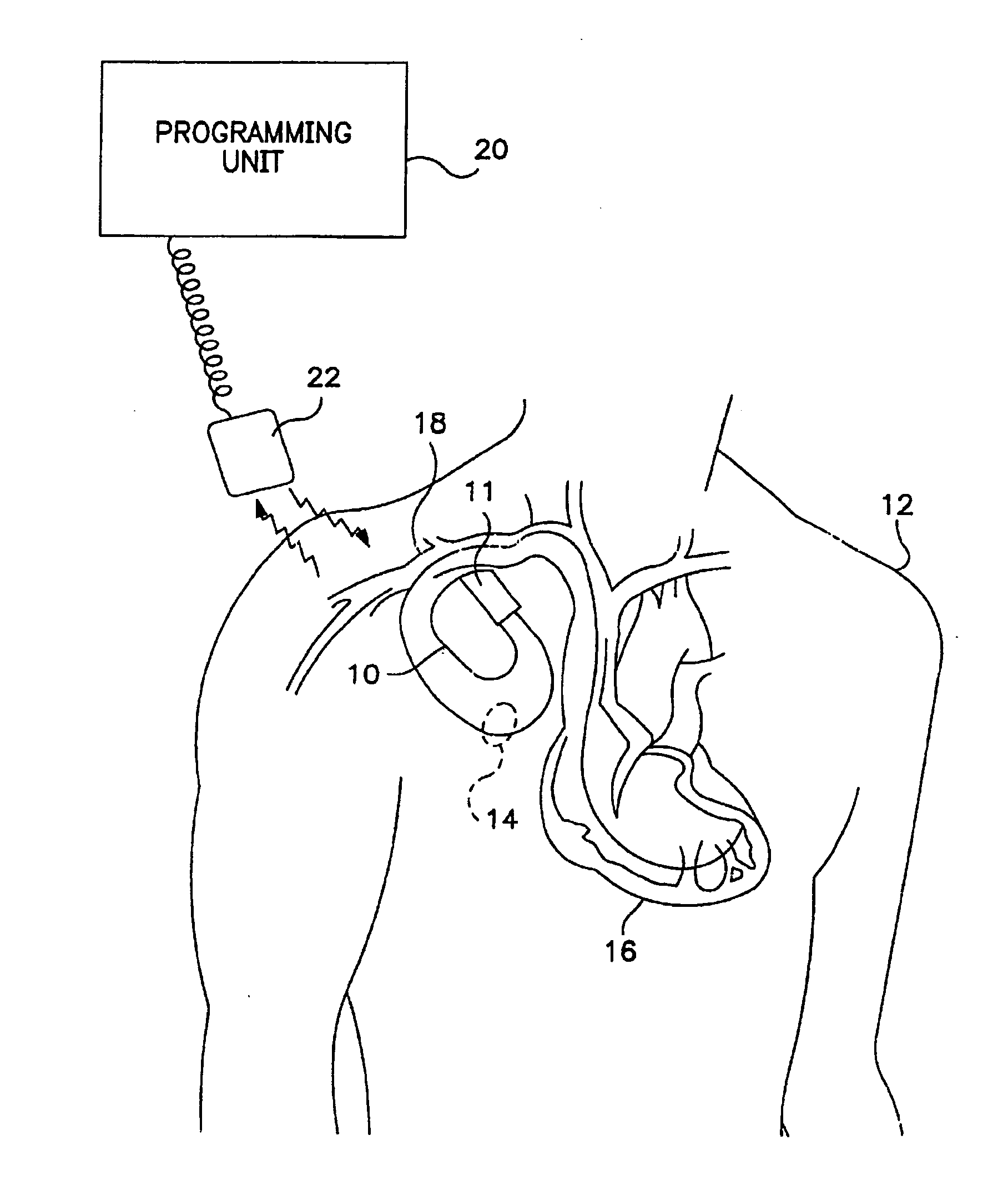 Method of optimizing mechanical heart rate during delivery of coupled or paired pacing