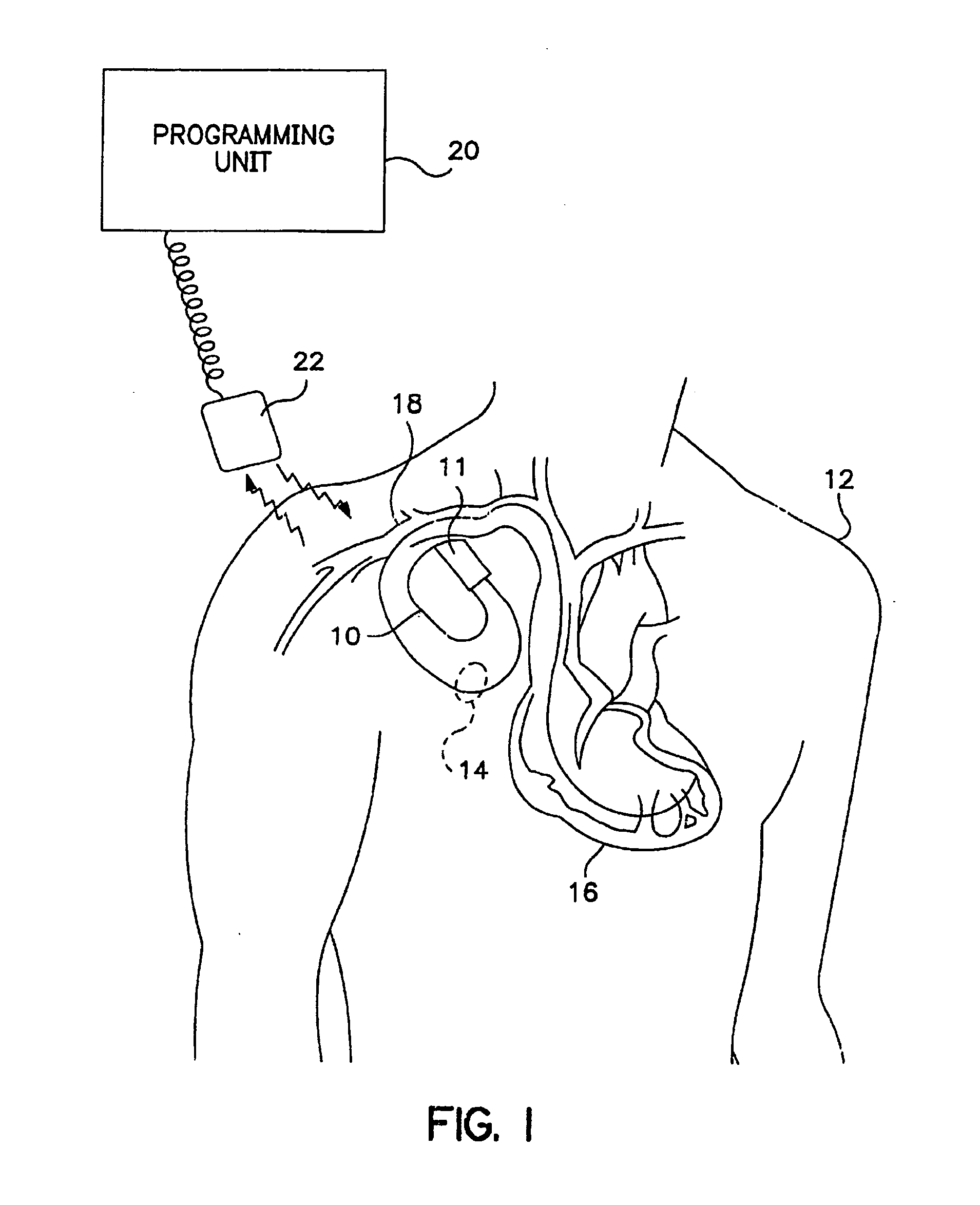 Method of optimizing mechanical heart rate during delivery of coupled or paired pacing