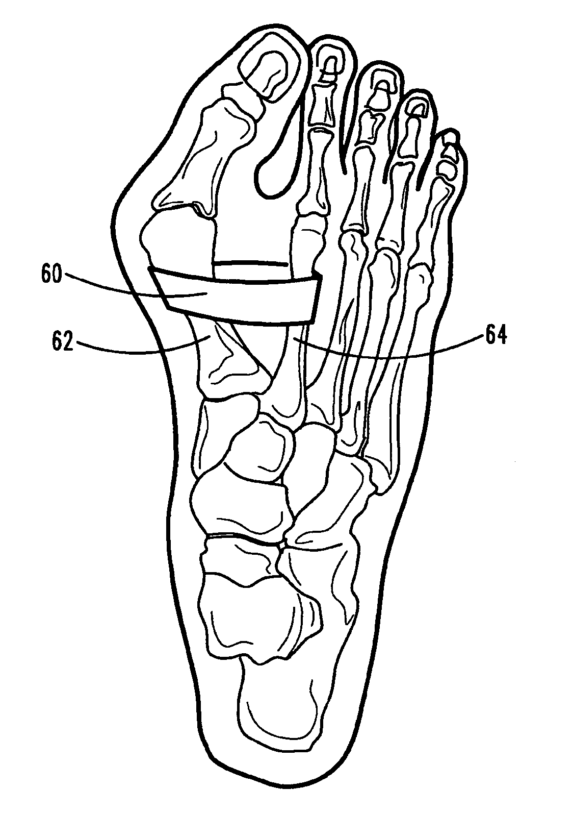 Methods and devices for treating hallux valgus